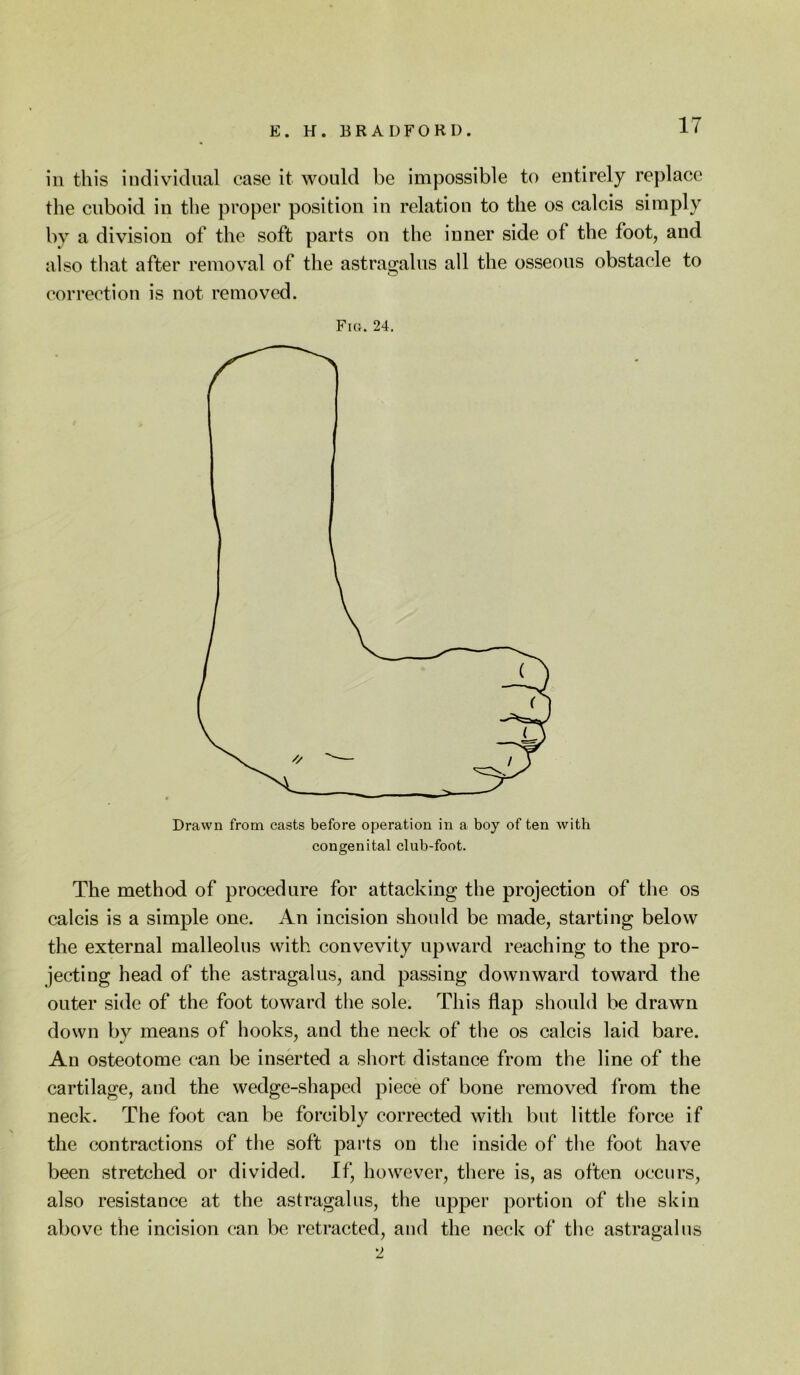 in this individual case it would be impossible to entirely replace the euboid in the proper position in relation to the os ealcis simply by a division of the soft parts on the inner side of the foot, and also that after remov’al of the astragalus all the osseous obstacle to correction is not removed. FiOr. 24. Drawn from casts before operation in a boy of ten with congenital club-foot. The method of procedure for attacking the projection of the os calcis is a simple one. An incision should be made, starting below the external malleolus with convevity upward reaching to the pro- jecting head of the astragalus, and passing downward toward the outer side of the foot toward the sole. This flap should be drawn down by means of hooks, and the neck of the os calcis laid bare. An osteotome can be inserted a short distance from the line of the cartilage, and the wedge-shaped piece of bone removed from the neck. The foot can be forcibly corrected with but little force if the contractions of the soft parts on the inside of the foot have been stretched or divided. If, however, there is, as often occurs, also resistance at the astragalus, the upper portion of the skin above the incision can be retracted, and the neck of the astragalus ‘2