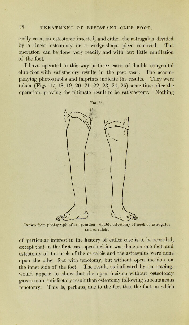 easily seen, an osteotome inserted, and either the astragalus divided by a linear osteotomy or a wedge-shape piece removed. The operation can be done very readily and with but little mutilation of the foot. I have operated in this way in three cases of double congenital club-foot with satisfactory results in the past year. The accom- panying photographs and imprints indicate the results. They were taken (Figs. 17,18,19, 20, 21, 22, 23, 24, 25) some time after the operation, proving the ultimate result to be satisfactory. Nothing Fig. 25. Drawn from photograph after operation—double osteotomy of neck of astragalus and os calcis. of particular interest in the history of either case is to be recorded, except that in the first case open incision was done on one foot, and osteotomy of the neck of the os calcis and the astragalus were done upon the other foot with tenotomy, but without open incisiou on the inner side of the foot. The result, as indicated by the tracing, would appear to show that the open incision without osteotomy gave a more satisfactory result than osteotomy following subcutaneous tenotomy. This is, perhaps, due to the fact that the foot on which