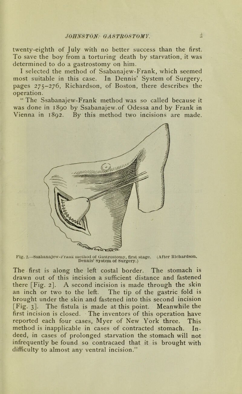 .1 twenty-eighth of July with no better success than the first. To save the boy from a torturing death by starvation, it was determined to do a gastrostomy on him. I selected the method of Ssabanajew-Frank, which seemed most suitable in this case. In Dennis’ System of Surgery, pages 275-276, Richardson, of Boston, there describes the operation. “ The Ssabanajew-Frank method was so called because it was done in 1890 by Ssabanajew. of Odessa and by Frank in Vienna in 1892. By this method two incisions are made. Fig. 2.—Ssabanajew-FrauK iiieDliod of Gastrostomy, first stage. (After Richardson, Dennis’ System of Surgery.) The first is along the left costal border. The stomach is drawn out of this incision a sufficient distance and fastened there [Fig. 2]. A second incision is made through the skin an inch or two to the left. The tip of the gastric fold is brought under the skin and fastened into this second incision [Fig. 3]. The fistula is made at this point. Meanwhile the first incision is closed. 'The inventors of this operation have reported each four cases, Myer of New York three. This method is inapplicable in cases of contracted stomach. In- deed, in cases of prolonged starvation the stomach will not infrequently be found so contracaed that it is brought with difficulty to almost any ventral incision.”