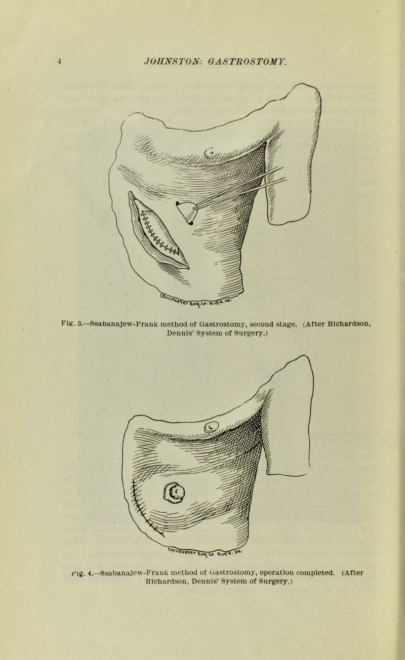 Fiff. 3.—Ssabanajew-Frank method of Gastrostomy, second stage. (After Richardson, Dennis’ System of Surgery.) 4.—Ssahanajew-Frank method of Gastrostomy, operation completed. (After Richardson, Dennis’ System of Surgery.)