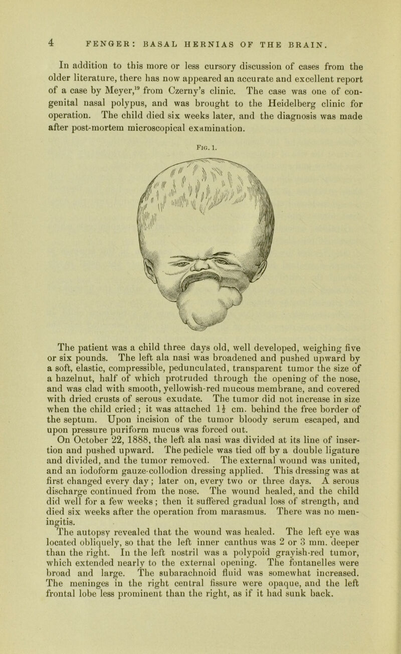 In addition to this more or less cursory discussion of cases from the older literature, there has now appeared an accurate and excellent report of a case by Meyer,19 from Czerny’s clinic. The case was one of con- genital nasal polypus, and was brought to the Heidelberg clinic for operation. The child died six weeks later, and the diagnosis was made after post-mortem microscopical examination. Fig. 1. The patient was a child three days old, well developed, weighing five or six pounds. The left ala nasi was broadened and pushed upward by a soft, elastic, compressible, pedunculated, transparent tumor the size of a hazelnut, half of which protruded through the opening of the nose, and was clad with smooth, yellowish-red mucous membrane, and covered with dried crusts of serous exudate. The tumor did not increase in size when the child cried; it was attached H cm. behind the free border of the septum. Upon incision of the tumor bloody serum escaped, and upon pressure puriform mucus was forced out. On October 22, 1888, the left ala nasi was divided at its line of inser- tion and pushed upward. The pedicle was tied off by a double ligature and divided, and the tumor removed. The external wound was united, and an iodoform gauze-collodion dressing applied. This dressing was at first changed every day; later on, every two or three days. A serous discharge continued from the nose. The wound healed, and the child did well for a few weeks; then it suffered gradual loss of strength, and died six weeks after the operation from marasmus. There was no men- ingitis. The autopsy revealed that the wound was healed. The left eye was located obliquely, so that the left inner canthus was 2 or 3 mm. deeper than the right. In the left nostril was a polypoid grayish-red tumor, which extended nearly to the external opening. The fontanelles were broad and large. The subarachnoid fluid was somewhat increased. The meninges in the right central fissure were opaque, and the left frontal lobe less prominent than the right, as if it had sunk back.