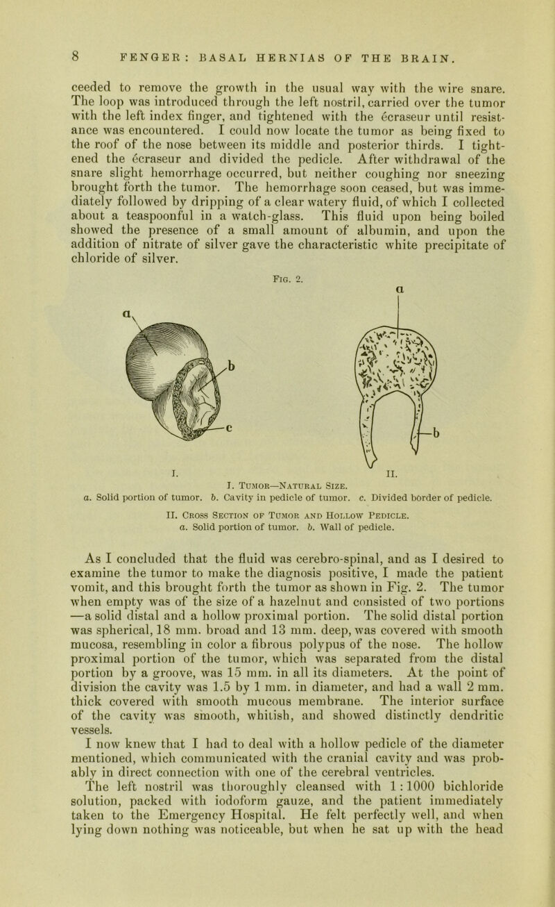 ceeded to remove the growth in the usual way with the wire snare. The loop was introduced through the left nostril, carried over the tumor with the left index finger, and tightened with the ecraseur until resist- ance was encountered. I could now locate the tumor as being fixed to the roof of the nose between its middle and posterior thirds. I tight- ened the ecraseur and divided the pedicle. After withdrawal of the snare slight hemorrhage occurred, but neither coughing nor sneezing brought forth the tumor. The hemorrhage soon ceased, but was imme- diately followed by dripping of a clear watery fluid, of which I collected about a teaspoonful in a watch-glass. This fluid upon being boiled showed the presence of a small amount of albumin, and upon the addition of nitrate of silver gave the characteristic white precipitate of chloride of silver. Fig. 2. a I. Tumor—Natural Size. a. Solid portion of tumor, b. Cavity in pedicle of tumor, c. Divided border of pedicle. II. Cross Section of Tumor and Hollow Pedicle. a. Solid portion of tumor, b. Wall of pedicle. As I concluded that the fluid was cerebro-spinal, and as I desired to examine the tumor to make the diagnosis positive, I made the patient vomit, and this brought forth the tumor as shown in Fig. 2. The tumor when empty was of the size of a hazelnut and consisted of two portions —a solid distal and a hollow proximal portion. The solid distal portion was spherical, 18 mm. broad and 13 mm. deep, was covered with smooth mucosa, resembling in color a fibrous polypus of the nose. The hollow proximal portion of the tumor, which was separated from the distal portion by a groove, was 15 mm. in all its diameters. At the point of division the cavity was 1.5 by 1 mm. in diameter, and had a wall 2 mm. thick covered with smooth mucous membrane. The interior surface of the cavity was smooth, whitish, and showed distinctly dendritic vessels. I now knew that I had to deal with a hollow pedicle of the diameter mentioned, which communicated with the cranial cavity and was prob- ably in direct connection with one of the cerebral ventricles. The left nostril was thoroughly cleansed with 1:1000 bichloride solution, packed with iodoform gauze, and the patient immediately taken to the Emergency Hospital. He felt perfectly well, and when lying down nothing was noticeable, but when he sat up with the head