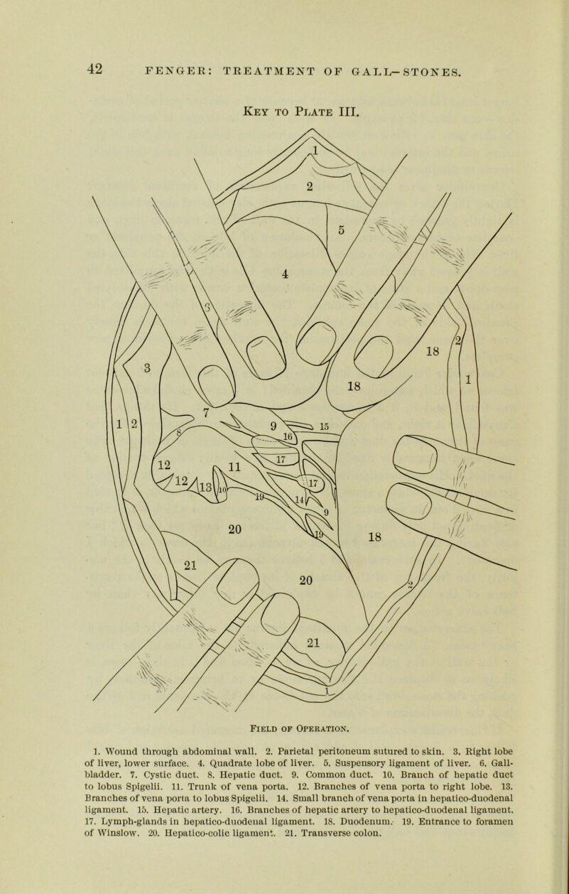 Key to Plate III. 1. Wound through abdominal wall. 2. Parietal peritoneum sutured to skin. 3. Right lobe of liver, lower surface. 4. Quadrate lobe of liver. 5. Suspensory ligament of liver. 6. Gall- bladder. 7. Cystic duct. 8. Hepatic duct. 9. Common duct. 10. Branch of hepatic duct to lobus Spigelii. 11. Trunk of vena porta. 12. Branches of vena porta to right lobe. 13. Branches of vena porta to lobus Spigelii. 14. Small branch of vena porta in hepatico-duodenal ligament. 15. Hepatic artery. 16. Branches of hepatic artery to hepatico-duodenal ligament. 17. Lymph-glands in hepatico-duodenal ligament. 18. Duodenum. 19. Entrance to foramen of Winslow. 20. Hepatico-colic ligament. 21. Transverse colon.