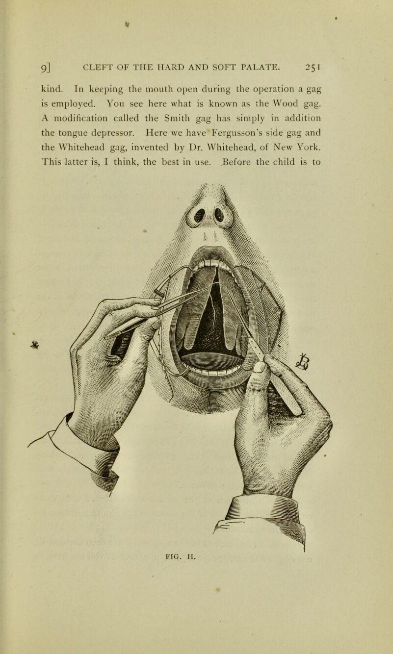 u 9] CLEFT OF THE HARD AND SOFT PALATE. 25 I kind. In keeping the mouth open during the o})eration a gag is employed. You see here what is known as the Wood gag. A modification called the Smith gag has simply in addition the tongue depressor. Here we have PYrgusson’s side gag and the Ydiitehead gag, invented by Dr. Whitehead, of New York. This latter is, I think, the best in use. .Before the child is to FIG. II