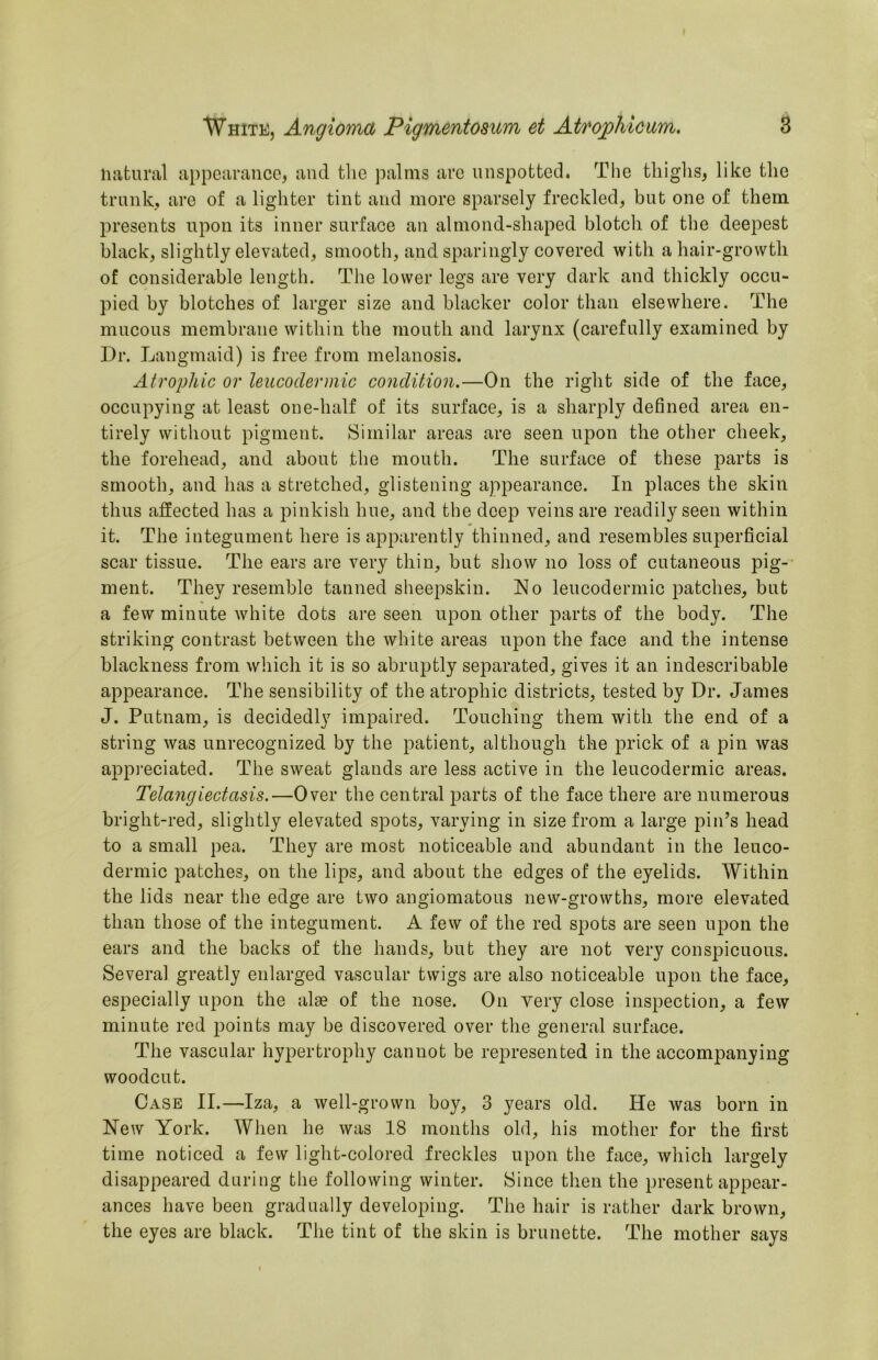 liatural appearance, and the palms are unspotted. The tliiglis, like the trank, are of a lighter tint and more sparsely freckled, but one of them presents npon its inner surface an almond-shaped blotch of the deepest black, slightly elevated, smooth, and sparingly covered with a hair-growth of considerable length. The lower legs are very dark and thickly occu- pied by blotches of larger size and blacker color than elsewhere. The mucous membrane within the mouth and larynx (carefully examined by Dr. Langmaid) is free from melanosis. Atrophic or leucodermic condition.—On the right side of the face, occupying at least one-half of its surface, is a sharply defined area en- tirely without pigment. Similar areas are seen upon the other cheek, the forehead, and about the mouth. The surface of these parts is smooth, and has a stretched, glistening appearance. In places the skin thus affected has a pinkish hue, and the deep veins are readily seen within it. The integument here is apparently thinned, and resembles superficial scar tissue. The ears are very thin, but show no loss of cutaneous pig-' ment. They resemble tanned sheepskin. No leucodermic patches, but a few minute white dots are seen npon other parts of the body. The striking contrast between the white areas upon the face and the intense blackness from which it is so abruptly separated, gives it an indescribable appearance. The sensibility of the atrophic districts, tested by Dr. James J. Putnam, is decidedly impaired. Touching them with the end of a string was unrecognized by the patient, although the prick of a pin was appi’eciated. The sweat glands are less active in the leucodermic areas. Telangiectasis.—Over the central parts of the face there are numerous bright-red, slightly elevated spots, varying in size from a large pin’s head to a small pea. They are most noticeable and abundant in the leuco- dermic patches, on the lips, and about the edges of the eyelids. Within the lids near the edge are two angiomatous new-growths, more elevated than those of the integument. A few of the red spots are seen upon the ears and the backs of the hands, but they are not very conspicuous. Several greatly enlarged vascular twigs are also noticeable upon the face, especially upon the alae of the nose. On very close inspection, a few minute red points may be discovered over the general surface. The vascular hypertrophy cannot be represented in the accompanying woodcut. Case II.—Iza, a well-grown boy, 3 years old. He was born in New York. When he was 18 months old, his mother for the first time noticed a few light-colored freckles upon the face, which largely disappeared during the following winter. Since then the present appear- ances have been gradually developing. The hair is rather dark brown, the eyes are black. The tint of the skin is brunette. The mother says