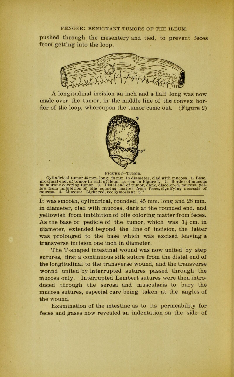 pushed through the mesentery and tied, to prevent feces from getting into the loop. A longitudinal incision an inch and a half long was now made over the tumor, in the middle line of the convex bor- der of the loop, whereupon the tumor came out. (Figure 2) Figure 2—Tumor. Cylindrical tumor 45 mm. Ions; 28 mm. in diameter, clad with mucosa. 1. Base, proximal end, of tumor in wall of ileum as seen in Figure 1. 2. Border of mucous membrane covering tumor. 3. Distal end of tumor, dark, discolored, mucosa yel- low from imbibition of bile coloring matter from feces, signifying necrosis of mucosa. 4. Mucosa: Light red, ecchymosis at‘•5.” It was smooth, cylindrical, rounded, 45 mm. long and 28 mm. in diameter, clad with mucosa, dark at the rounded end, and yellowish from imbibition of bile coloring matter from feces. As the base or pedicle of the tumor, which was cm. in diameter, extended beyond the line of incision, the latter was prolonged to the base which was excised leaving a transverse incision one inch in diameter. The T-shaped intestinal wound was now united by step sutures, first a continuous silk suture from the distal end of the longitudinal to the transverse wound, and the transverse wound united by interrupted sutures passed through the mucosa only. Interrupted Lembert sutures were then intro- duced through the serosa and muscularis to bury the mucosa sutures, especial care being taken at the angles of the wound. Examination of the intestine as to its permeability for feces and gases now revealed an indentation on the side of