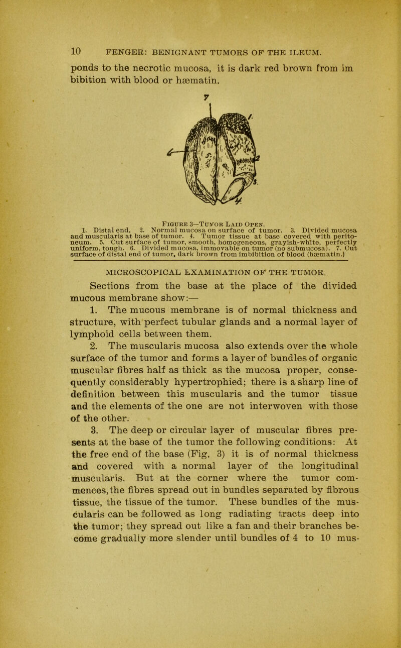 ponds to the necrotic mucosa, it is dark red brown from im bibition with blood or hscmatin. Figure 3—Tustor Laid Open. 1. Distal end. 2. Normal mucosa on surface of tumor. 3. Divided mucosa and muscularis at base of tumor. 4. Tumor tissue at base covered with perito- neum. 5. Cut surface of tumor, smooth, homogeneous, grayish-white, perfectly uniform, tough. 6. Divided mucosa, immovable on tumor (no submucosa). 7. Cut surface of distal end of tumor, dark brown from imbibition of blood (haematin.) MICROSCOPICAL EXAMINATION OP THE TUMOR. Sections from the base at the place of the divided mucous membrane show:— 1. The mucous membrane is of normal thickness and structure, with perfect tubular glands and a normal layer of lymphoid cells between them. 2. The muscularis mucosa also extends over the whole surface of the tumor and forms a layer of bundles of organic muscular fibres half as thick as the mucosa proper, conse- quently considerably hypertrophied; there is a sharp line of definition between this muscularis and the tumor tissue and the elements of the one are not interwoven with those of the other. 3. The deep or circular layer of muscular fibres pre- sents at the base of the tumor the following conditions: At the free end of the base (Fig. 3) it is of normal thickness and covered with a normal layer of the longitudinal muscularis. But at the corner where the tumor com- mences, the fibres spread out in bundles separated by fibrous tissue, the tissue of the tumor. These bundles of the mus- cularis can be followed as long radiating tracts deep into the tumor; they spread out like a fan and their branches be- come gradually more slender until bundles of 4 to 10 mus-