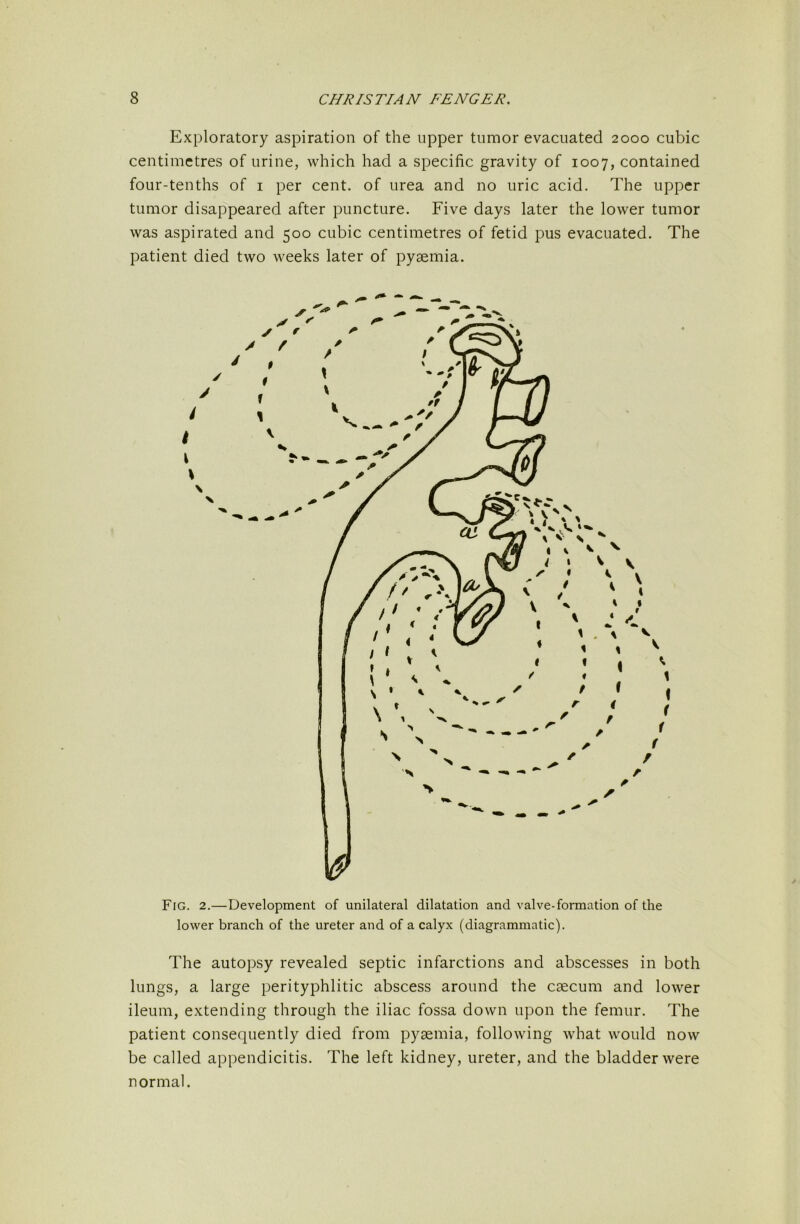 Exploratory aspiration of the upper tumor evacuated 2000 cubic centimetres of urine, which had a specific gravity of 1007, contained four-tenths of i per cent, of urea and no uric acid. The upper tumor disappeared after puncture. Five days later the lower tumor was aspirated and 500 cubic centimetres of fetid pus evacuated. The patient died two weeks later of pyaemia. I \ Fig. 2.—Development of unilateral dilatation and valve-formation of the lower branch of the ureter and of a calyx (diagrammatic). The autopsy revealed septic infarctions and abscesses in both lungs, a large perityphlitic abscess around the caecum and lower ileum, extending through the iliac fossa down upon the femur. The patient consequently died from pyaemia, following what would now be called appendicitis. The left kidney, ureter, and the bladder were normal.