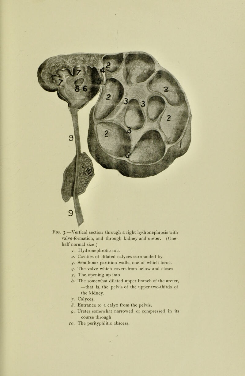 Fig. 3.—Vertical section through a right hydronephrosis with valve-formation, and through kidney and ureter. (One- half normal size.) /. Hydronephrotic sac. 2. Cavities of dilated calyces surrounded by j. Semilunar partition walls, one of which forms 4. The valve which covers from below and closes j. The opening up into 6. The somewhat dilated upper branch of the ureter, —that is, the pelvis of the upper two-thirds of the kidney. 7. Calyces. 8. Entrance to a calyx from the pelvis. 9. Ureter somewhat narrowed or compressed in its course through 10. The perityphlitic abscess.