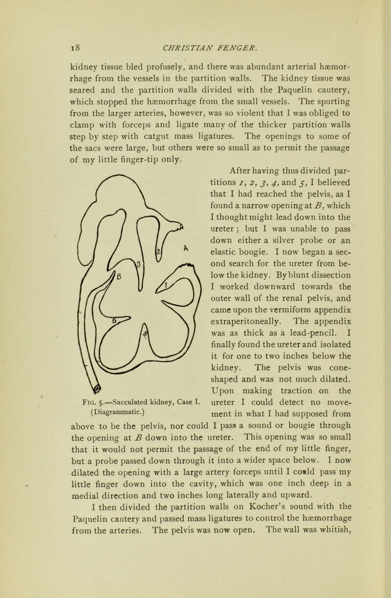 kidney tissue bled profusely, and there was abundant arterial haemor- rhage from the vessels in the partition walls. The kidney tissue was seared and the partition walls divided with the Paquelin cautery, which stopped the haemorrhage from the small vessels. The spurting from the larger arteries, however, was so violent that I was obliged to clamp with forceps and ligate many of the thicker partition walls step by step with catgut mass ligatures. The openings to some of the sacs were large, but others were so small as to permit the passage of my little finger-tip only. After having thus divided par- titions 7, 2, j, 4, and 5, I believed that I had reached the pelvis, as I found a narrow opening at B, which I thought might lead down into the ureter; but I was unable to pass down either a silver probe or an elastic bougie. I now began a sec- ond search for the ureter from be- low the kidney. By blunt dissection I worked downward towards the outer wall of the renal pelvis, and came upon the vermiform appendix extraperitoneally. The appendix was as thick as a lead-pencil. I finally found the ureter and isolated it for one to two inches below the kidney. The pelvis was cone- shaped and was not much dilated. Upon making traction on the Fig. 5.—Sacculated kidney. Case I. ureter I could detect no move- (Diagrammatic.) ment ill what I had supposed from above to be the pelvis, nor could I pass a sound or bougie through the opening at B down into the ureter. This opening was so small that it would not permit the passage of the end of my little finger, but a probe passed down through it into a wider space below. I now dilated the opening with a large artery forceps until I coild pass my little finger down into the cavity, which was one inch deep in a medial direction and two inches long laterally and upward. I then divided the partition walls on Kocher’s sound with the Paquelin cautery and passed mass ligatures to control the haemorrhage from the arteries. The pelvis was now open. The wall was whitish.