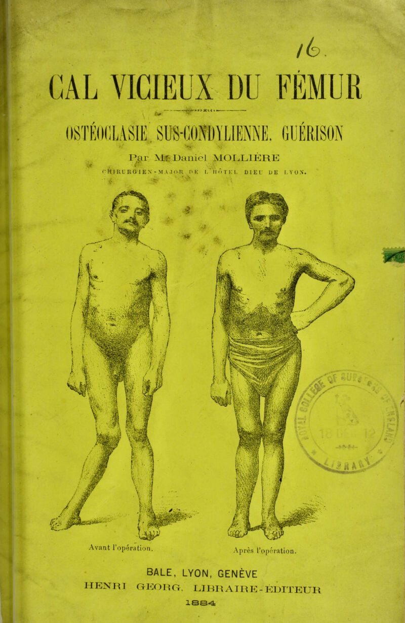 Avant l’opération, Après l’opération. BALE, LYON, GENÈVE Henri GtKohct. libraire-éditeur —<>Xu » < IV Tin arm; k 1LAS™ et •• Cl il U. U Par Daniel MOLLIERE & f ft'l RU R G I E X - M A J O-R HE l/’ïl Ô TEL DIEU DE LYON 1884