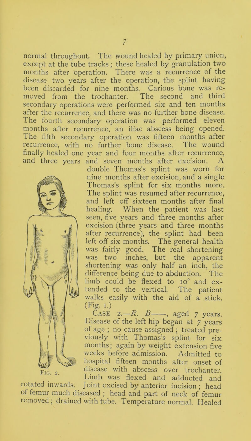 normal throughout. The wound healed by primary union, except at the tube tracks; these healed by granulation two months after operation. There was a recurrence of the disease two years after the operation, the splint having been discarded for nine months. Carious bone was re- moved from the trochanter. The second and third secondary operations were performed six and ten months after the recurrence, and there was no further bone disease. The fourth secondary operation was performed eleven months after recurrence, an iliac abscess being opened. The fifth secondary operation was fifteen months after recurrence, with no further bone disease. The wound finally healed one year and four months after recurrence, and seven months after excision. A double Thomas’s splint was worn for nine months after excision, and a single Thomas’s splint for six months more. The splint was resumed after recurrence, and left off sixteen months after final healing. When the patient was last seen, five years and three months after excision (three years and three months after recurrence), the splint had been left off six months. The general health was fairly good. The real shortening was two inches, but the apparent shortening was only half an inch, the difference being due to abduction. The limb could be flexed to io° and ex- tended to the vertical. The patient walks easily with the aid of a stick. (Fig- i.) Case 2.—R. B , aged 7 years. Disease of the left hip began at 7 years of age ; no cause assigned ; treated pre- viously with Thomas’s splint for six months; again by weight extension five weeks before admission. Admitted to hospital fifteen months after onset of disease with abscess over trochanter. Limb was flexed and adducted and Joint excised by anterior incision ; head of femur much diseased ; head and part of neck of femur removed ; drained with tube. Temperature normal. Healed and three years rotated inwards.