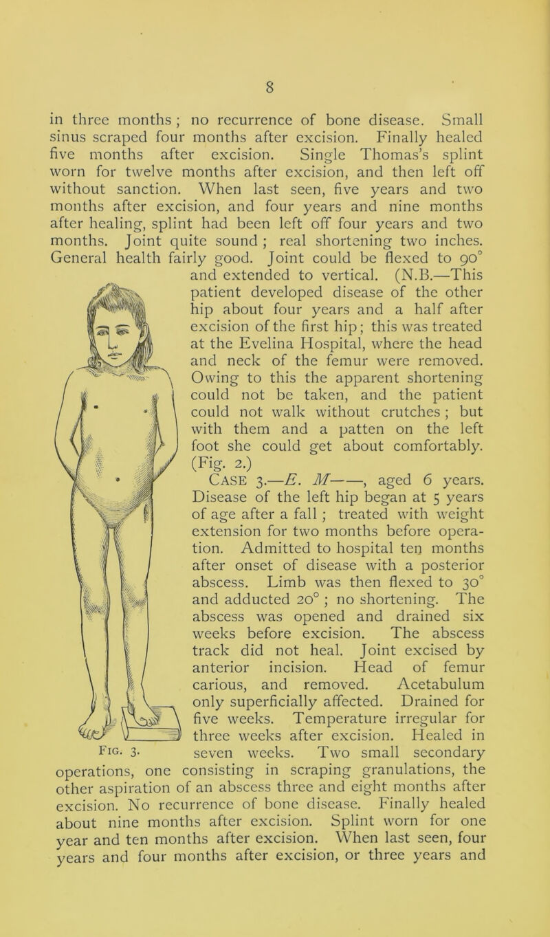 in three months ; no recurrence of bone disease. Small sinus scraped four months after excision. Finally healed five months after excision. Single Thomas’s splint worn for twelve months after excision, and then left off without sanction. When last seen, five years and two months after excision, and four years and nine months after healing, splint had been left off four years and two months. Joint quite sound ; real shortening two inches. General health fairly good. Joint could be flexed to 90° and extended to vertical. (N.B.—This patient developed disease of the other hip about four years and a half after excision of the first hip; this was treated at the Evelina Hospital, where the head and neck of the femur were removed. Owing to this the apparent shortening could not be taken, and the patient could not walk without crutches; but with them and a patten on the left foot she could get about comfortably. (Fig. 2.) CASE 3.—E. M , aged 6 years. Disease of the left hip began at 5 years of age after a fall ; treated with weight extension for two months before opera- tion. Admitted to hospital ten months after onset of disease with a posterior abscess. Limb was then flexed to 30° and adducted 20° ; no shortening. The abscess was opened and drained six weeks before excision. The abscess track did not heal. Joint excised by anterior incision. Head of femur carious, and removed. Acetabulum only superficially affected. Drained for five weeks. Temperature irregular for three weeks after excision. Healed in Fig- 3- seven weeks. Two small secondary operations, one consisting in scraping granulations, the other aspiration of an abscess three and eight months after excision. No recurrence of bone disease. Finally healed about nine months after excision. Splint worn for one year and ten months after excision. When last seen, four years and four months after excision, or three years and