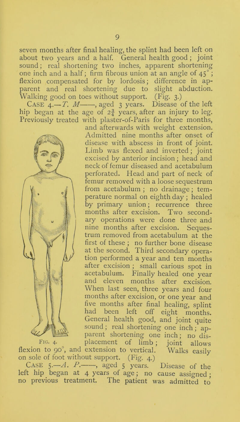 seven months after final healing, the splint had been left on about two years and a half. General health good ; joint sound; real shortening two inches, apparent shortening one inch and a half; firm fibrous union at an angle of 450; flexion compensated for by lordosis; difference in ap- parent and real shortening due to slight abduction. Walking good on toes without support. (Fig. 3.) Case 4.— T. M , aged 3 years. Disease of the left hip began at the age of 2f years, after an injury to leg. Previously treated with plaster-of-Paris for three months, and afterwards with weight extension. Admitted nine months after onset of disease with abscess in front of joint. Limb was flexed and inverted; joint excised by anterior incision ; head and neck of femur diseased and acetabulum perforated. Head and part of neck of femur removed with a loose sequestrum from acetabulum ; no drainage; tem- perature normal on eighth day ; healed by primary union; recurrence three months after excision. Two second- ary operations were done three and nine months after excision. Seques- trum removed from acetabulum at the first of these ; no further bone disease at the second. Third secondary opera- tion performed a year and ten months after excision ; small carious spot in acetabulum. Finally healed one year and eleven months after excision. When last seen, three years and four months after excision, or one year and five months after final healing, splint had been left off eight months. General health good, and joint quite sound ; real shortening one inch; ap- parent shortening one inch; no dis- placement of limb ; joint allows flexion to 90°, and extension to vertical. Walks easily on sole of foot without support. (Fig. 4.) Case 5.—A. P. , aged 5 years. Disease of the left hip began at 4 years of age; no cause assigned ; no previous treatment. The patient was admitted to* Fig. 4.