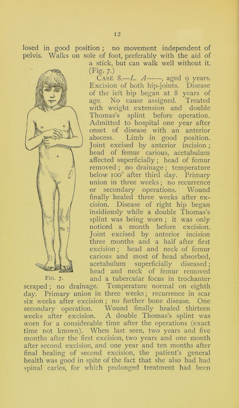 losed in good position ; no movement independent of pelvis. Walks on sole of foot, preferably with the aid of Case 8.—L. A , aged 9 years. Excision of both hip-joints. Disease of the left hip began at 8 years of age. No cause assigned. Treated with weight extension and double Thomas’s splint before operation. Admitted to hospital one year after union in three weeks; no recurrence or secondary operations. Wound finally healed three weeks after ex- cision. Disease of right hip began insidiously while a double Thomas’s noticed a month before excision. Joint excised by anterior incision I | I I three months and a half after first I { | / excision ; head and neck of femur pH I i carious and most of head absorbed, -c / U J acetabulum superficially diseased; head and neck of femur removed Fig. 7. and a tubercular focus in trochanter scraped; no drainage. Temperature normal on eighth day. Primary union in three weeks; recurrence in scar six weeks after excision ; no further bone disease. One secondary operation. Wound finally healed thirteen weeks after excision. A double Thomas’s splint was worn for a considerable time after the operations (exact time not known). When last seen, two years and five months after the first excision, two years and one month after second excision, and one year and ten months after final healing of second excision, the patient’s general health was good in spite of the fact that she also had had spinal caries, for which prolonged treatment had been a stick, but can walk well without it. onset of disease with an anterior abscess. Limb in good position. Joint excised by anterior incision ; head of femur carious, acetabulum affected superficially ; head of femur removed ; no drainage ; temperature below ioo° after third day. Primary splint was being worn ; it was only