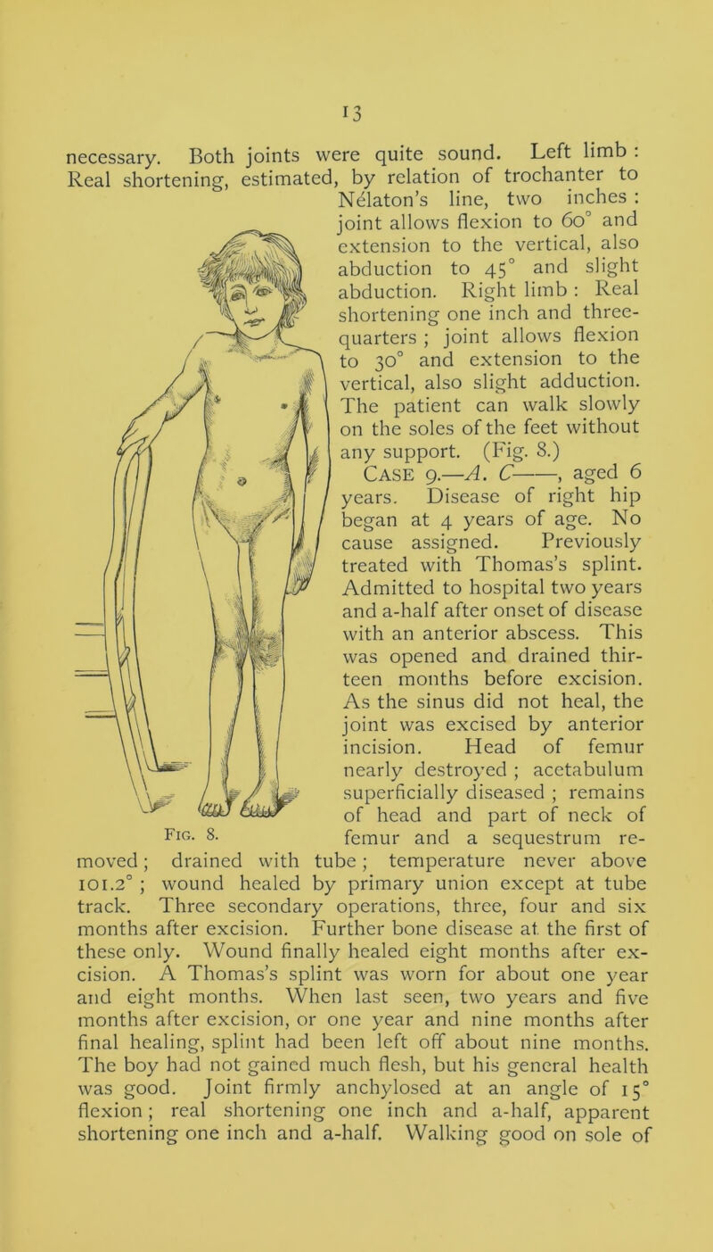 aged 6 necessary. Both joints were quite sound. Left limb : Real shortening, estimated, by relation of trochanter to Nelaton’s line, two inches : joint allows flexion to 6o° and extension to the vertical, also abduction to 450 and slight abduction. Right limb : Real shortening one inch and three- quarters ; joint allows flexion to 30° and extension to the vertical, also slight adduction. The patient can walk slowly on the soles of the feet without any support. (Fig. S.) Case 9.—A. C , years. Disease of right hip began at 4 years of age. No cause assigned. Previously treated with Thomas’s splint. Admitted to hospital two years and a-half after onset of disease with an anterior abscess. This was opened and drained thir- teen months before excision. As the sinus did not heal, the joint was excised by anterior incision. Head of femur nearly destroyed ; acetabulum superficially diseased ; remains of head and part of neck of Fig- 8- femur and a sequestrum re- moved ; drained with tube; temperature never above 101.20 ; wound healed by primary union except at tube track. Three secondary operations, three, four and six months after excision. Further bone disease at. the first of these only. Wound finally healed eight months after ex- cision. A Thomas’s splint was worn for about one year and eight months. When last seen, two years and five months after excision, or one year and nine months after final healing, splint had been left off about nine months. The boy had not gained much flesh, but his general health was good. Joint firmly anchylosed at an angle of 15° flexion; real shortening one inch and a-half, apparent shortening one inch and a-half. Walking good on sole of