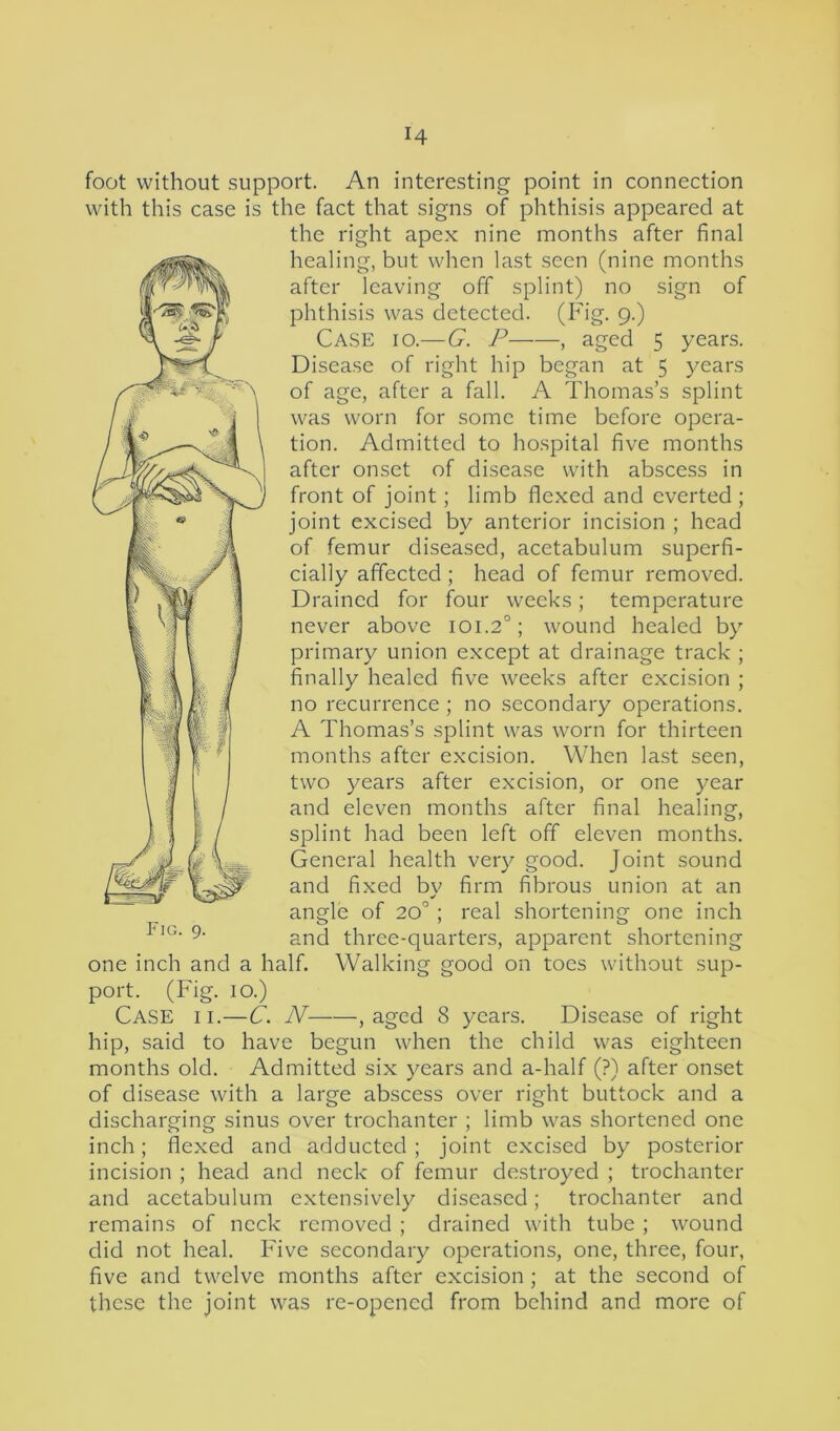 foot without support. An interesting point in connection with this case is the fact that signs of phthisis appeared at the right apex nine months after final healing, but when last seen (nine months after leaving off splint) no sign of phthisis was detected. (Fig. 9.) Case 10.— G. P , aged 5 years. Disease of right hip began at 5 years of age, after a fall. A Thomas’s splint was worn for some time before opera- tion. Admitted to hospital five months after onset of disease with abscess in front of joint; limb flexed and everted; joint excised by anterior incision ; head of femur diseased, acetabulum superfi- cially affected ; head of femur removed. Drained for four weeks; temperature never above 101.20; wound healed by primary union except at drainage track ; finally healed five weeks after excision ; no recurrence; no secondary operations. A Thomas’s splint was worn for thirteen months after excision. When last seen, two years after excision, or one year and eleven months after final healing, splint had been left off eleven months. General health very good. Joint sound and fixed by firm fibrous union at an angle of 20°; real shortening one inch and three-quarters, apparent shortening one inch and a half. Walking good on toes without sup- port. (Fig. 10.) Case ii.—C. N , aged 8 years. Disease of right hip, said to have begun when the child was eighteen months old. Admitted six years and a-half (?) after onset of disease with a large abscess over right buttock and a discharging sinus over trochanter ; limb was shortened one inch; flexed and adducted; joint excised by posterior incision ; head and neck of femur destroyed ; trochanter and acetabulum extensively diseased; trochanter and remains of neck removed ; drained with tube ; wound did not heal. Five secondary operations, one, three, four, five and twelve months after excision ; at the second of these the joint was re-opened from behind and more of