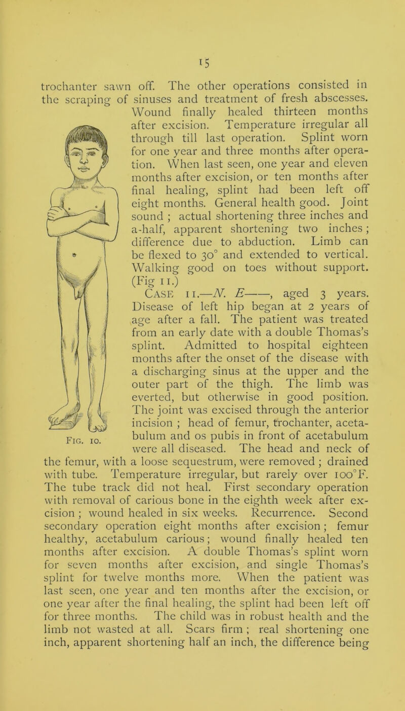 trochanter sawn off. The other operations consisted in the scraping of sinuses and treatment of fresh abscesses. Wound finally healed thirteen months after excision. Temperature irregular all through till last operation. Splint worn for one year and three months after opera- tion. When last seen, one year and eleven months after excision, or ten months after final healing, splint had been left off eight months. General health good. Joint sound ; actual shortening three inches and a-half, apparent shortening two inches; difference due to abduction. Limb can be flexed to 30° and extended to vertical. Walking good on toes without support. (Fig 11.) Case ii.—N. E , aged 3 years. Disease of left hip began at 2 years of age after a fall. The patient was treated from an early date with a double Thomas’s splint. Admitted to hospital eighteen months after the onset of the disease with a discharging sinus at the upper and the outer part of the thigh. The limb was everted, but otherwise in good position. The joint was excised through the anterior incision ; head of femur, trochanter, aceta- bulum and os pubis in front of acetabulum were all diseased. The head and neck of the femur, with a loose sequestrum, were removed ; drained with tube. Temperature irregular, but rarely over ioo°F. The tube track did not heal. First secondary operation with removal of carious bone in the eighth week after ex- cision ; wound healed in six weeks. Recurrence. Second secondary operation eight months after excision ; femur healthy, acetabulum carious; wound finally healed ten months after excision. A double Thomas’s splint worn for seven months after excision, and single Thomas’s splint for twelve months more. When the patient was last seen, one year and ten months after the excision, or one year after the final healing, the splint had been left off for three months. The child was in robust health and the limb not wasted at all. Scars firm ; real shortening one inch, apparent shortening half an inch, the difference being