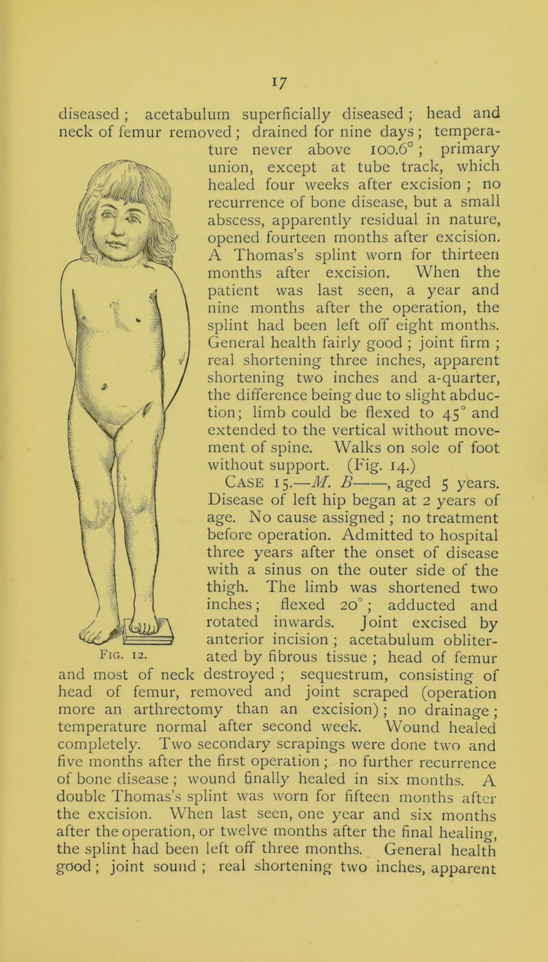 diseased; acetabulum superficially diseased; head and neck of femur removed; drained for nine days; tempera- ture never above ioo.6°; primary union, except at tube track, which healed four weeks after excision ; no recurrence of bone disease, but a small abscess, apparently residual in nature, opened fourteen months after excision. A Thomas’s splint worn for thirteen months after excision. When the patient was last seen, a year and nine months after the operation, the splint had been left off eight months. General health fairly good ; joint firm ; real shortening three inches, apparent shortening two inches and a-quarter, the difference being due to slight abduc- tion; limb could be flexed to 450 and extended to the vertical without move- ment of spine. Walks on sole of foot without support. (Fig. 14.) Case 15.—M. B , aged 5 years. Disease of left hip began at 2 years of age. No cause assigned ; no treatment before operation. Admitted to hospital three years after the onset of disease with a sinus on the outer side of the thigh. The limb was shortened two inches; flexed 20°; adducted and rotated inwards. Joint excised by anterior incision ; acetabulum obliter- ated by fibrous tissue ; head of femur and most of neck destroyed ; sequestrum, consisting of head of femur, removed and joint scraped (operation more an arthrectomy than an excision); no drainage; temperature normal after second week. Wound healed completely. Two secondary scrapings were done two and five months after the first operation; no further recurrence of bone disease; wound finally healed in six months. A double Thomas’s splint was worn for fifteen months after the excision. When last seen, one year and six months after the operation, or twelve months after the final healing, the splint had been left off three months. General health good ; joint sound ; real shortening two inches, apparent