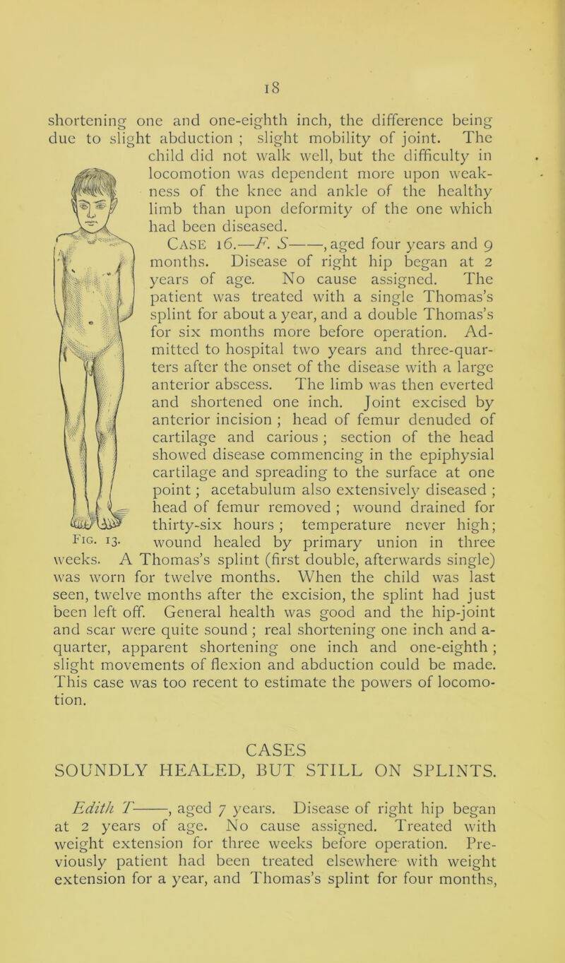 shortening one and one-eighth inch, the difference being due to slight abduction ; slight mobility of joint. The child did not walk well, but the difficulty in locomotion was dependent more upon weak- ness of the knee and ankle of the healthy limb than upon deformity of the one which had been diseased. Case 16.—F. S , aged four years and 9 months. Disease of right hip began at 2 years of age. No cause assigned. The patient was treated with a single Thomas’s splint for about a year, and a double Thomas’s for six months more before operation. Ad- mitted to hospital two years and three-quar- ters after the onset of the disease with a large anterior abscess. The limb was then everted and shortened one inch. Joint excised by anterior incision ; head of femur denuded of cartilage and carious ; section of the head showed disease commencing in the epiphysial cartilage and spreading to the surface at one point; acetabulum also extensively diseased ; head of femur removed ; wound drained for thirty-six hours; temperature never high; wound healed by primary union in three weeks. A Thomas’s splint (first double, afterwards single) was worn for twelve months. When the child was last seen, twelve months after the excision, the splint had just been left off. General health was good and the hip-joint and scar were quite sound ; real shortening one inch and a- quarter, apparent shortening one inch and one-eighth; slight movements of flexion and abduction could be made. This case was too recent to estimate the powers of locomo- tion. CASES SOUNDLY HEALED, BUT STILL ON SPLINTS. Edith T , aged 7 years. Disease of right hip began at 2 years of age. No cause assigned. Treated with weight extension for three weeks before operation. Pre- viously patient had been treated elsewhere with weight extension for a year, and Thomas’s splint for four months,