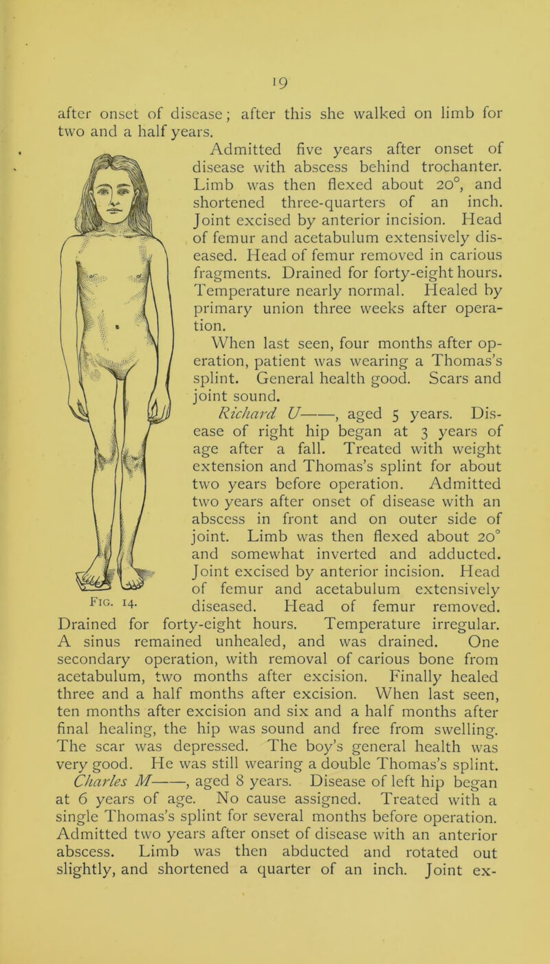 after onset of disease; after this she walked on limb for two and a half years. Admitted five years after onset of disease with abscess behind trochanter. Limb was then flexed about 20°, and shortened three-quarters of an inch. Joint excised by anterior incision. Head of femur and acetabulum extensively dis- eased. Head of femur removed in carious fragments. Drained for forty-eight hours. Temperature nearly normal. Healed by primary union three weeks after opera- tion. When last seen, four months after op- eration, patient was wearing a Thomas’s splint. General health good. Scars and joint sound. Richard U , aged 5 years. Dis- ease of right hip began at 3 years of age after a fall. Treated with weight extension and Thomas’s splint for about two years before operation. Admitted two years after onset of disease with an abscess in front and on outer side of joint. Limb was then flexed about 20° and somewhat inverted and adducted. Joint excised by anterior incision. Head of femur and acetabulum extensively diseased. Head of femur removed. Drained for forty-eight hours. Temperature irregular. A sinus remained unhealed, and was drained. One secondary operation, with removal of carious bone from acetabulum, two months after excision. Finally healed three and a half months after excision. When last seen, ten months after excision and six and a half months after final healing, the hip was sound and free from swelling. The scar was depressed. The boy’s general health was very good. He was still wearing a double Thomas’s splint. Charles M , aged 8 years. Disease of left hip began at 6 years of age. No cause assigned. Treated with a single Thomas’s splint for several months before operation. Admitted two years after onset of disease with an anterior abscess. Limb was then abducted and rotated out slightly, and shortened a quarter of an inch. Joint ex-