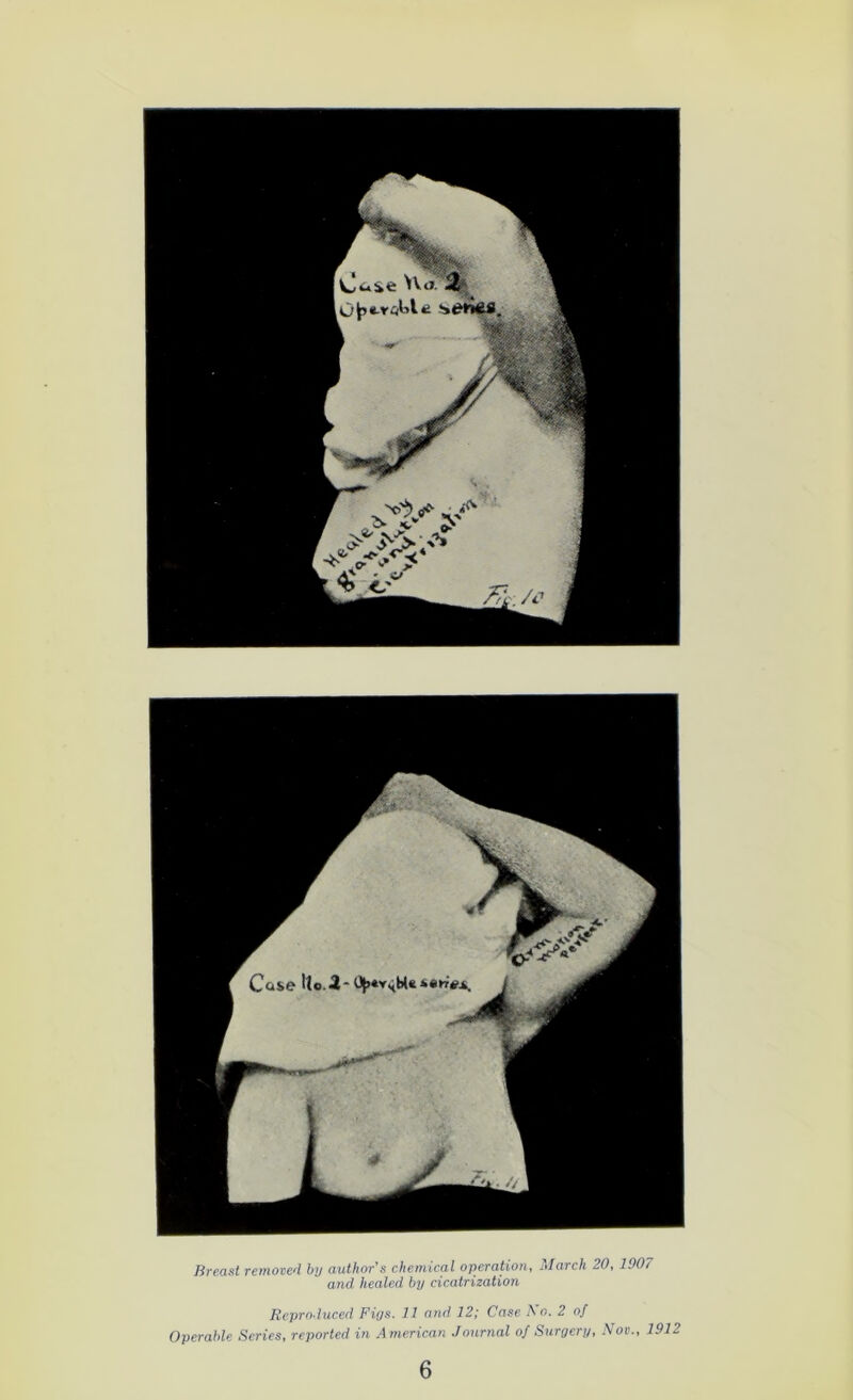 Breast removed by author's chemical operation, March 20, 1907 and healed by cicatrization Reproduced Figs. 11 and 12; Case A o. 2 of Operable Series, reported in American Journal of Surgery, Nov., 1912