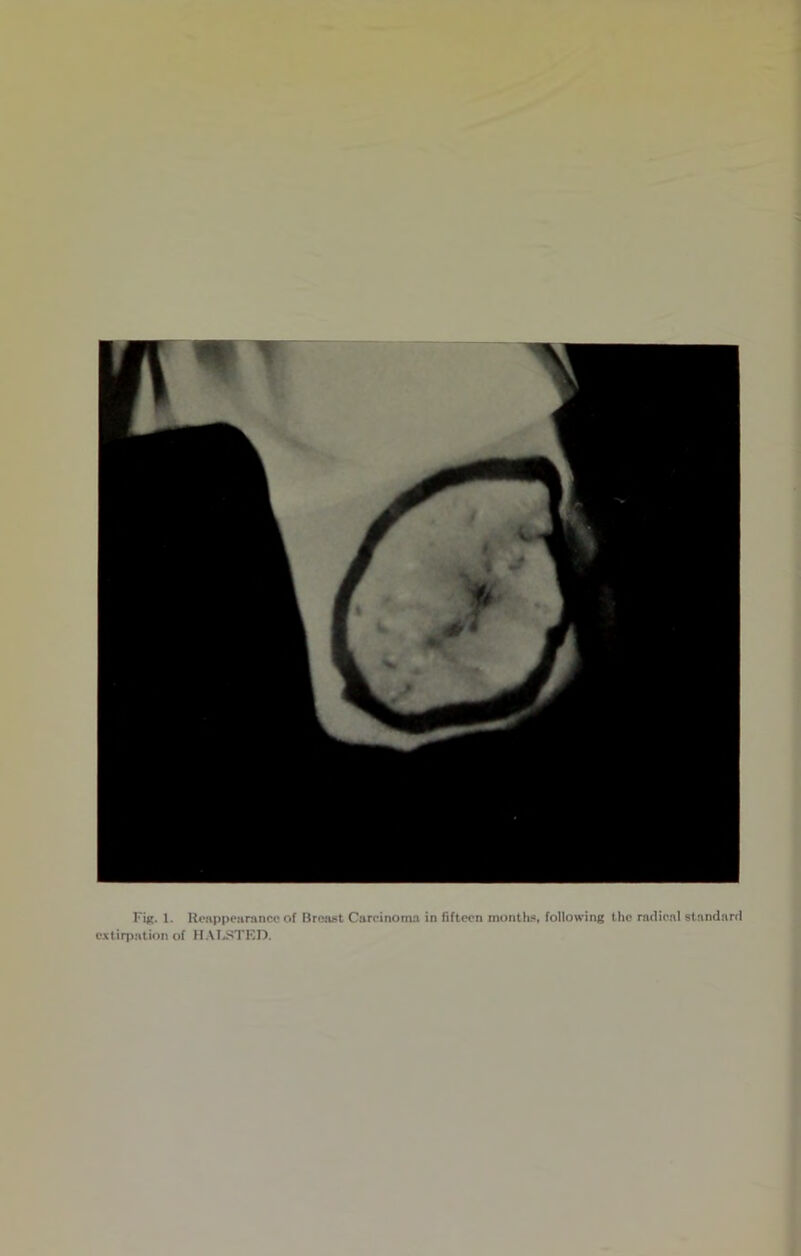 Fig. 1. Reappearance of Breast Carcinoma in fifteen months* following the radical standard extirpation of HALSTED.