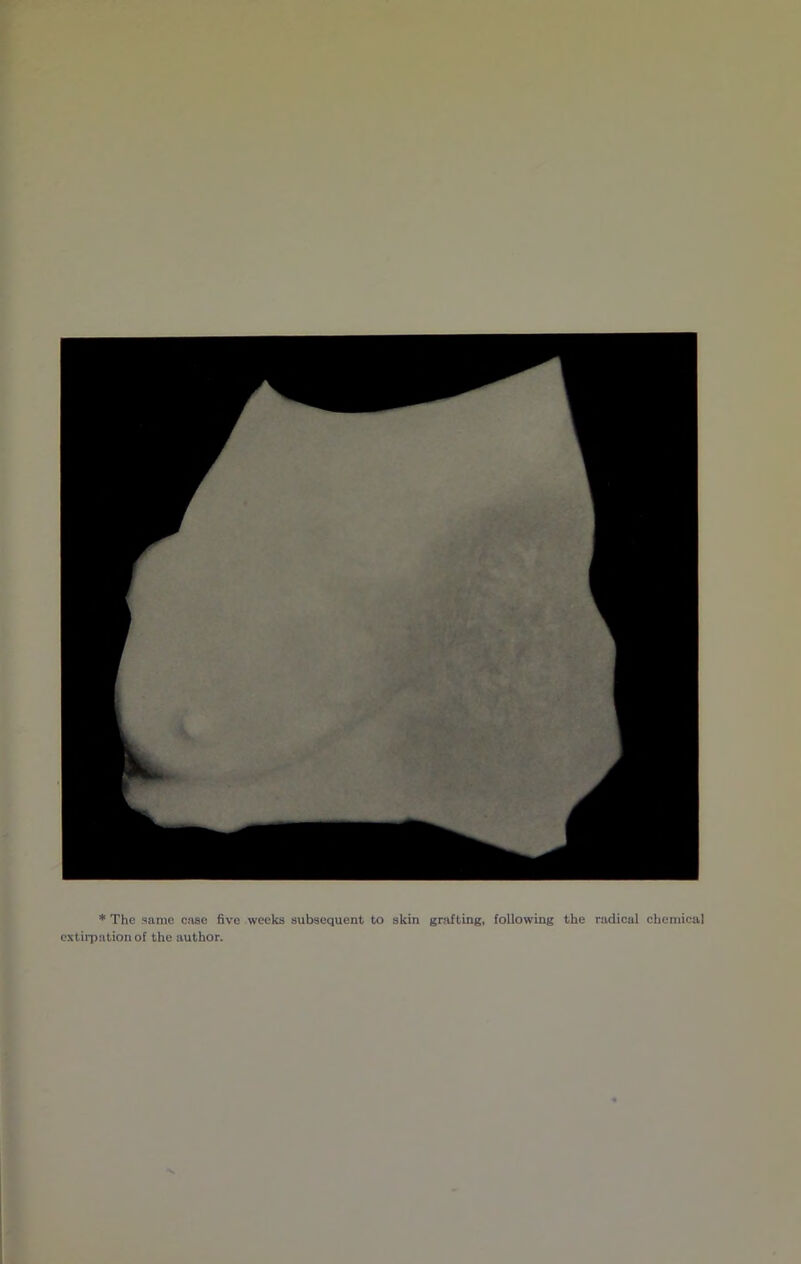 * The same case five weeks subsequent to skin grafting, following the radical chemical extiipation of the author.