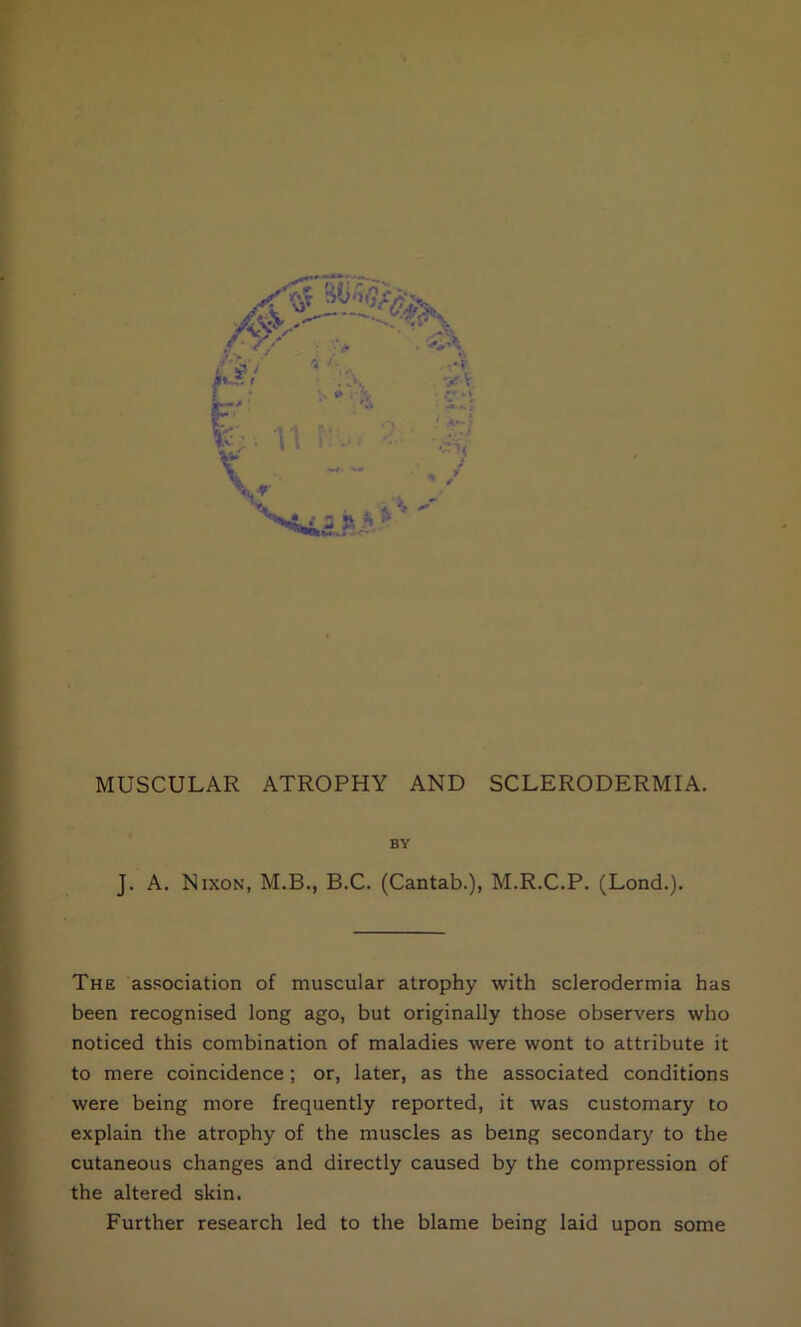MUSCULAR ATROPHY AND SCLERODERMIA. BY J. A. Nixon, M.B., B.C. (Cantab.), M.R.C.P. (Lond.). The association of muscular atrophy with sclerodermia has been recognised long ago, but originally those observers who noticed this combination of maladies were wont to attribute it to mere coincidence ; or, later, as the associated conditions were being more frequently reported, it was customary to explain the atrophy of the muscles as being secondary to the cutaneous changes and directly caused by the compression of the altered skin. Further research led to the blame being laid upon some
