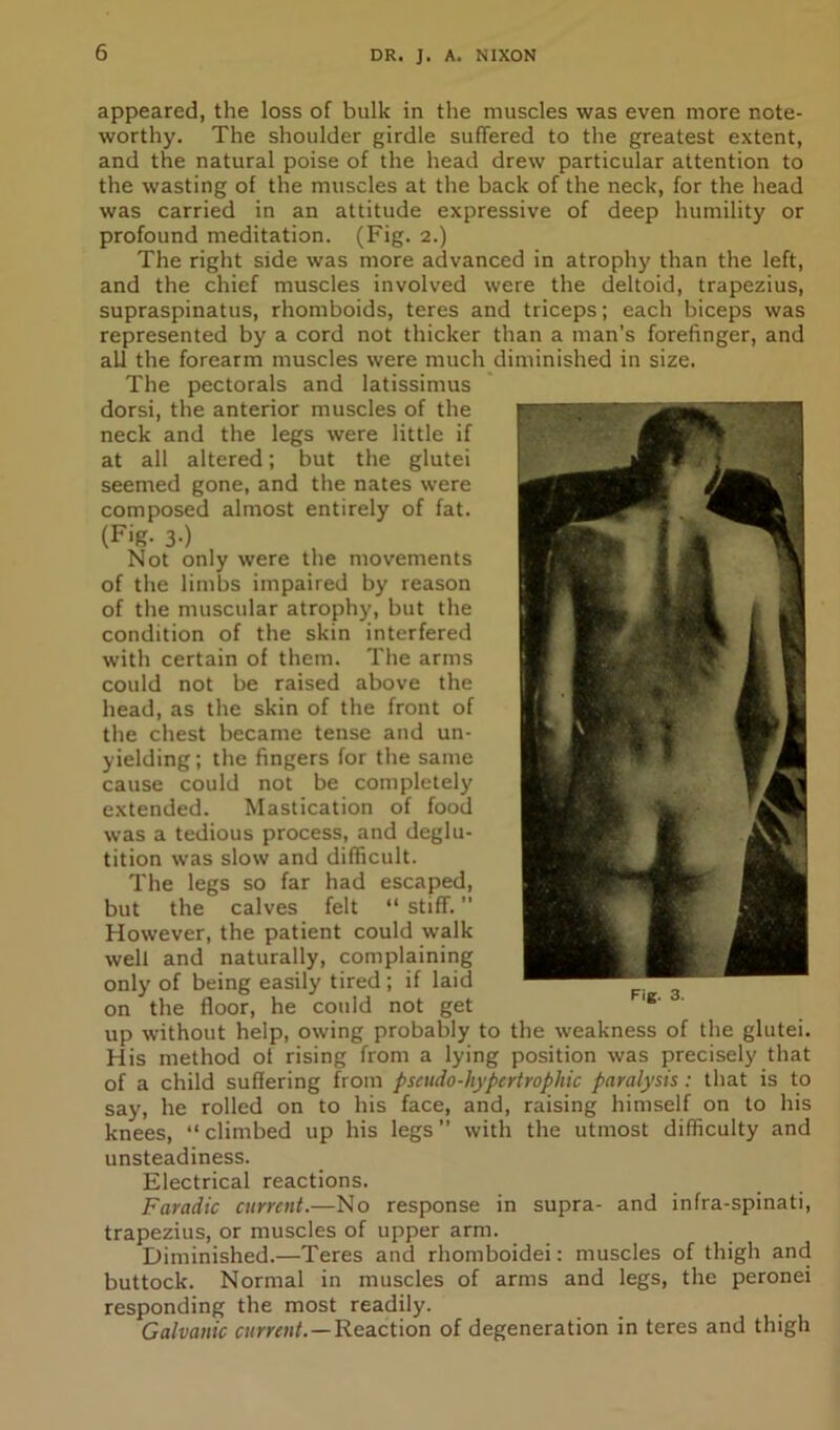 appeared, the loss of bulk in the muscles was even more note- worthy. The shoulder girdle suffered to the greatest extent, and the natural poise of the head drew particular attention to the wasting of the muscles at the back of the neck, for the head was carried in an attitude expressive of deep humility or profound meditation. (Fig. 2.) The right side was more advanced in atrophy than the left, and the chief muscles involved were the deltoid, trapezius, supraspinatus, rhomboids, teres and triceps; each biceps was represented by a cord not thicker than a man’s forefinger, and all the forearm muscles were much diminished in size. The pectorals and latissimus dorsi, the anterior muscles of the neck and the legs were little if at all altered; but the glutei seemed gone, and the nates were composed almost entirely of fat. (Fig. 3-) Not only were the movements of the limbs impaired by reason of the muscular atrophy, but the condition of the skin interfered with certain of them. The arms could not be raised above the head, as the skin of the front of the chest became tense and un- yielding; the fingers for the same cause could not be completely extended. Mastication of food was a tedious process, and deglu- tition was slow and difficult. The legs so far had escaped, but the calves felt “ stiff. ’’ However, the patient could walk- welt and naturally, complaining only of being easily tired ; if laid on the floor, he could not get up without help, owing probably to the weakness of the glutei. His method of rising from a lying position was precisely that of a child suffering from pseudo-hypertrophic paralysis: that is to say, he rolled on to his face, and, raising himself on to his knees, “ climbed up his legs ” with the utmost difficulty and unsteadiness. Electrical reactions. Faradic current.—No response in supra- and infra-spinati, trapezius, or muscles of upper arm. Diminished.—Teres and rhomboidei: muscles of thigh and buttock. Normal in muscles of arms and legs, the peronei responding the most readily. Galvanic current.—Reaction of degeneration in teres and thigh Fig. 3.