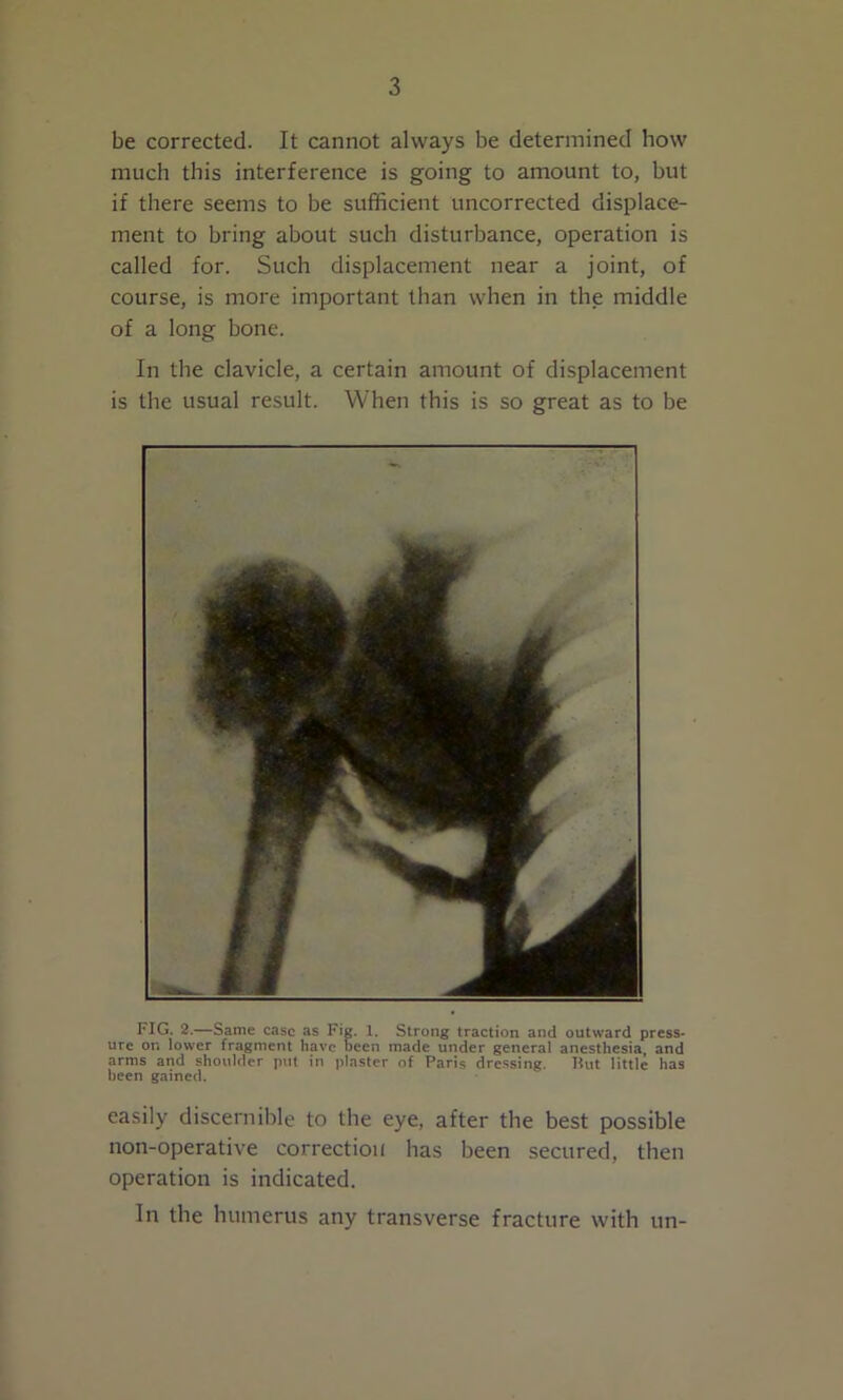 be corrected. It cannot always be determined how much this interference is going to amount to, but if there seems to be sufficient uncorrected displace- ment to bring about such disturbance, operation is called for. Such displacement near a joint, of course, is more important than when in the middle of a long bone. In the clavicle, a certain amount of displacement is the usual result. When this is so great as to be FIG. 2.—Same case as Fig. 1. Strong traction and outward press* ure on lower fragment have Been made under general anesthesia and arms and shoulder put in plaster of Paris dressing. Hut little has been gained. easily discernible to the eye, after the best possible non-operative correction has been secured, then operation is indicated. In the humerus any transverse fracture with un-