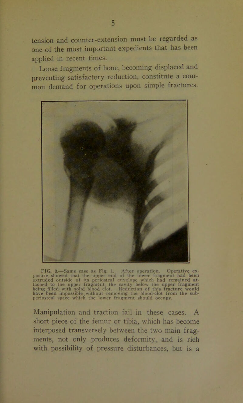tension and counter-extension must be regarded as one of the most important expedients that has been applied in recent times. Loose fragments of bone, becoming displaced and preventing satisfactory reduction, constitute a com- mon demand for operations upon simple fractures. FIG. 3.—Same case as Fig. 1. After operation. Operative ex- posure showed that the upper end of the lower fragment had been extruded outside of its periosteal envelope which had remained at- tached to the upper fragment the cavity helow the upper fragment being filled with solid blood clot. Reduction of this fracture would have been impossible without removing the blood-clot from the sub- periosteal space which the lower fragment should occupy. Manipulation and traction fail in these cases. A short piece of the femur or tibia, which has become interposed transversely between the two main frag- ments, not only produces deformity, and is rich with possibility of pressure disturbances, but is a