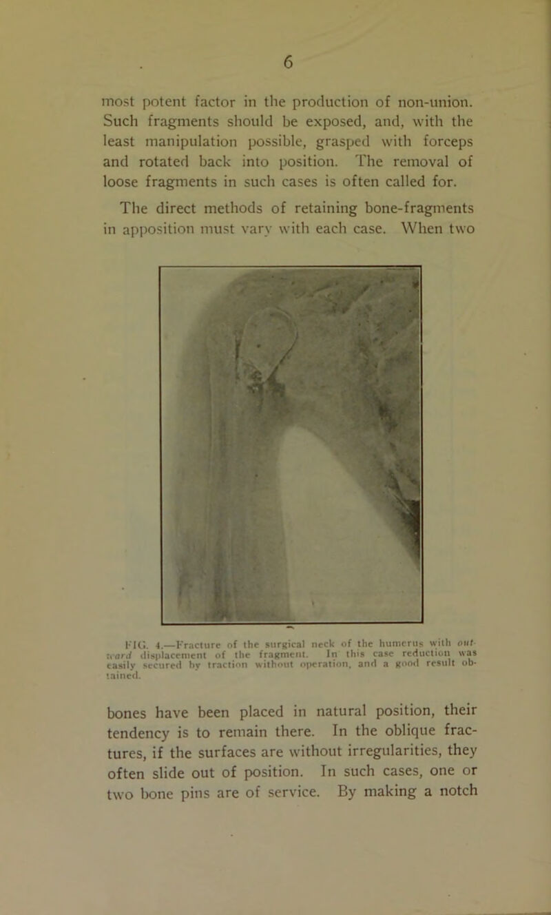 most potent factor in the production of non-union. Such fragments should be exposed, and, with the least manipulation possible, grasped with forceps and rotated back into position. The removal of loose fragments in such cases is often called for. The direct methods of retaining bone-fragments in apposition must vary with each case. When two KIG. 4.—Fracture of the surgical neck of the humerus wtth out- ward ilisplacemcnt of the fragment. In this case reduction was easily secured by traction without o|»eraiion, and a goo<l result ob* tained. bones have been placed in natural position, their tendency is to remain there. In the oblique frac- tures, if the surfaces are without irregularities, they often slide out of position. In such cases, one or two bone pins are of service. By making a notch