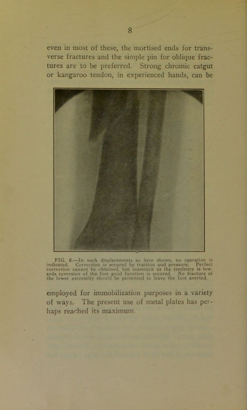 even in most of these, the mortised ends for trans- verse fractures and the simple pin for oblique frac- tures are to be preferred. Strong chromic catgut or kangaroo tendon, in experienced hands, can be FIG. 6.—In such displacements as here shown, no operation is indicated. Correction is secured by traction and pressure. Perfect correction cannot be obtained, but inasmuch as the tendency is tow. ards inversion of the foot good function is secured. No fracture of the lower extremity shouhl be permitted to leave the foot averted. employed for immobilization purposes in a variety of ways. The present use of metal plates has per-