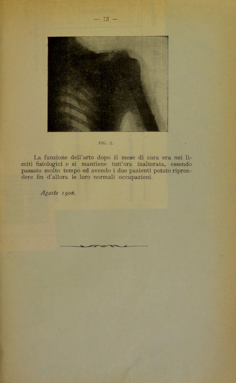 FIO. 2. La funzione dell’arto dopo il mese di cura era nei li- miti fisiologici e si mantiene tutt’ora inalterata, essendo passato molto tempo ed avendo i due pazienti potuto ripren- dere fin d’allora le loro normali occupazioni. Agosto 1906.