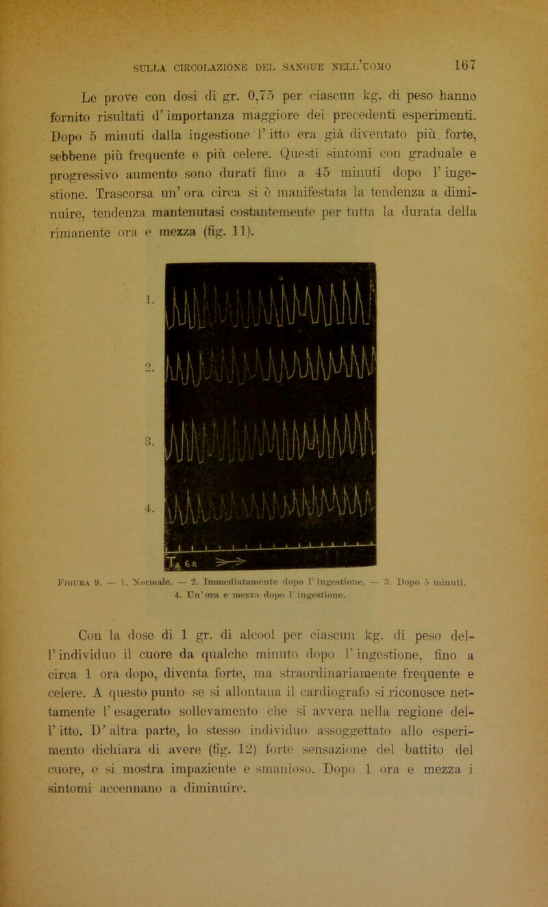 -, ■■■ir -. - .. •i'S . ' • .'■' , .. '• Le prove con dosi di ^r. 0,75 per ciascnn kg. di peso hanno fornito risultati d’importanza maggiore dei precedenti esperimenti. Dopo 5 minuti flalla ingestione l’itto era già diventato più forte, sebbene più frequente e più celere. Questi sintomi con gTaduale e progressivo aumento sojio durati fino a 45 minuti dopo l’inge- stione. Ti'ascorsa un’ ora circa si è manifestata la tendenza a dimi- nuire, tendenza mantenutasi costantemente per tutta la durata della rimanente ora «* mezza (fig. 11). 1. 3. 4. Fiouka y. — 1. Xoniijile. — 2. Imiiieiliatanirnto 1'hifrontioiie. — 3. Dopo ó mimiti. 4. Un’ora e iuozkìi <1o]>o l’inirostione. Con la dose di 1 gr. di alcool per ciascun kg. di peso del- l’individuo il cuore da qualche minuto dopo l'ingestione, fino a circa 1 ora dopo, diventa forte, ma straordinariamente frequente e celere. A questo punto se si allontana il cardiografo si riconosce net- tamente 1’ esagerato sollevamento che si avvera nella regione del- r itto. D’ altra parte, lo stesso individuo assoggettato allo esperi- mento dichiara di avere (tìg. 12) forte sensazione del battito del cuore, e si mostra impaziente e smanioso. Dopo 1 ora e mezza i sintomi accennano a diminuire.