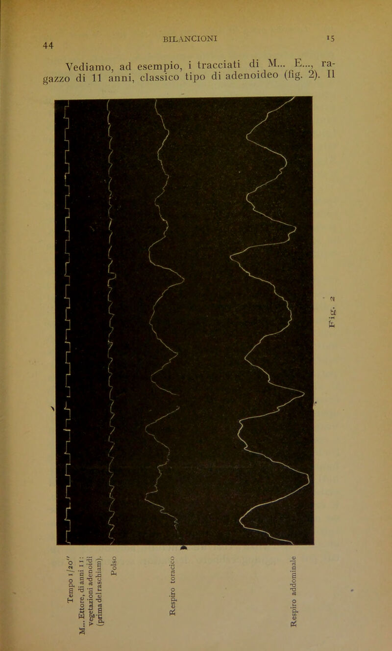 44 Vediamo, ad esempio, i tracciati di M... E..., ra- gazzo di n anni, classico tipo di adenoideo (iig. 2).