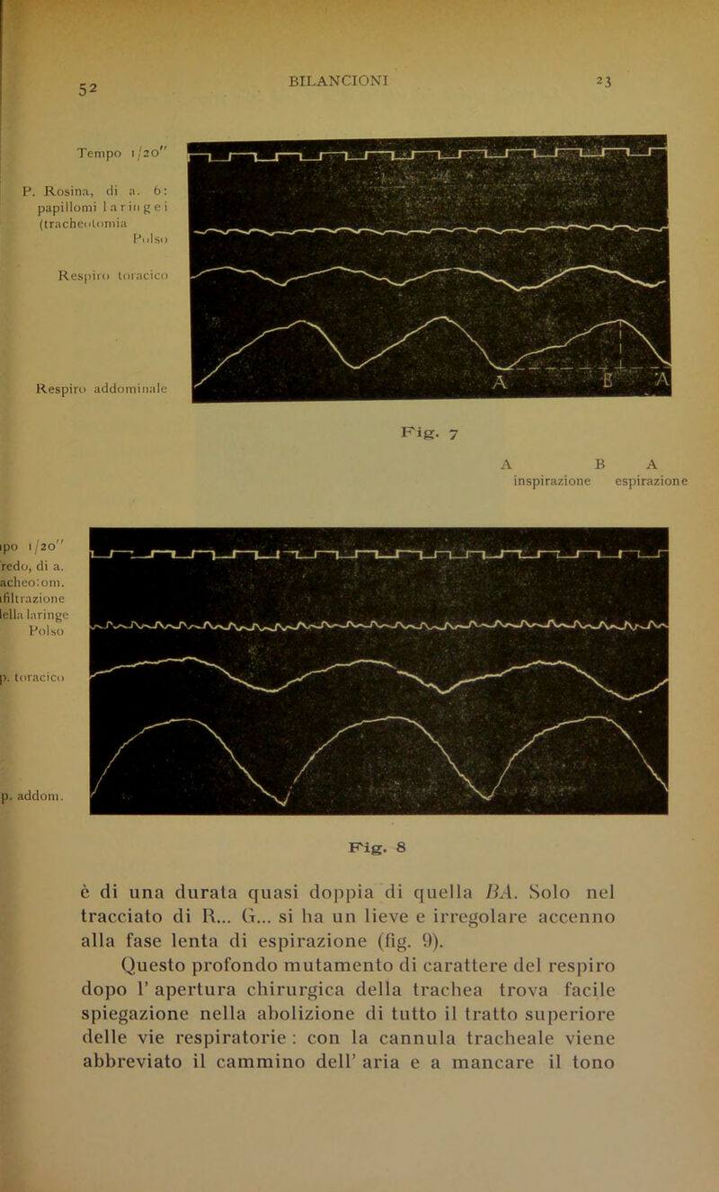 52 Tempo 1/20 P. Rosina, di a. 6: papillomi laringei (tracheiiloniia Pulso Respiro toracico Respiro addominale F'ig- 7 A B A inspirazione espirazione ipo 1/20 redo, di a. aclieo'.om. ifiltrazione Iella laringe Polso p. toracico p. addom. Rig. 8 è di una durata quasi doppia di quella HA. Solo nel tracciato di R... G... si ha un lieve e irregolare accenno alla fase lenta di espirazione (fig. 9). Questo profondo mutamento di carattere del respiro dopo 1’ apertura chirurgica della trachea trova facile spiegazione nella abolizione di tutto il tratto superiore delle vie respiratorie : con la cannula tracheale viene abbreviato il cammino dell’ aria e a mancare il tono