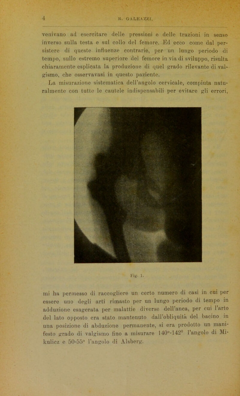 venivano ad esercitare delle pressioni e delle trazioni in senso inverso sulla testa e sul collo del femore. Ed ecco come dal per- sistere di queste influenze contrarie, per un lungo periodo di tempo, sullo estremo superiore del femore in via di sviluppo, risulta chiaramente esplicata la produzione di quel grado rilevante di val- gismo, che osservavasi in questo paziente. La misurazione sistematica dell’angolo cervicale, compiuta natu- ralmente con tutte le cautele indispensabili per evitare gli errori, h'ig. 1. mi ha permesso di raccogliere un certo numero di casi in cui per essere uno degli arti rimasto per un lungo periodo di tempo in adduzione esagerata per malattie diverse dell’anca, per cui 1 arto del lato opposto era stato mantenuto dall obliquità del bacino in una posizione di abduzione permanente, si era prodotto un mani- festo grado di valgismo tino a misurare 140M420 l’angolo di Mi- kulicz e 50-55° l’angolo di Alsberg.