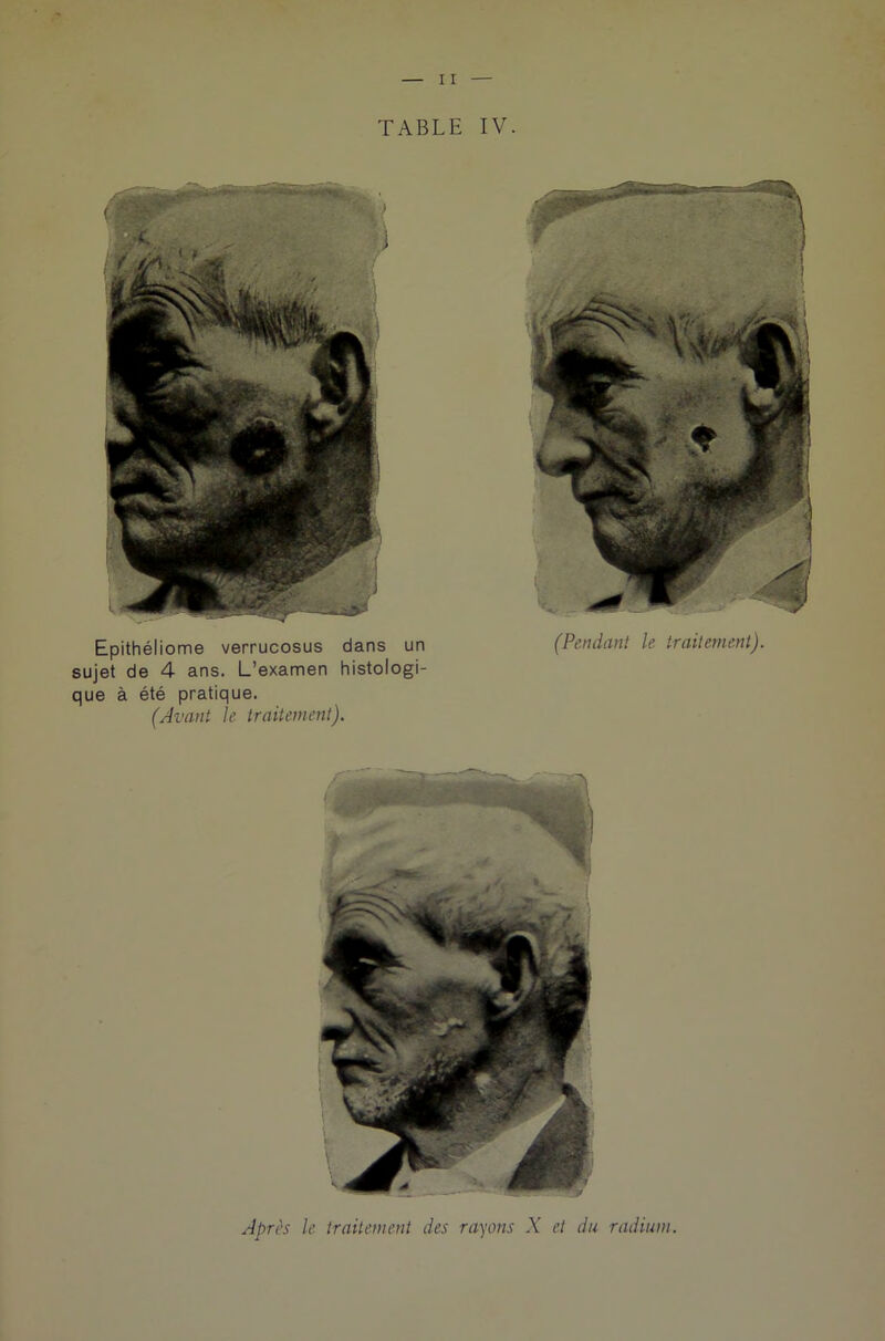 TABLE IV. Epithéliome verrucosus dans un sujet de 4 ans. L’examen histologi- que à été pratique. (Avant le traitement). (Pendant le traitement). Après le traitement des rayons X et du radium.