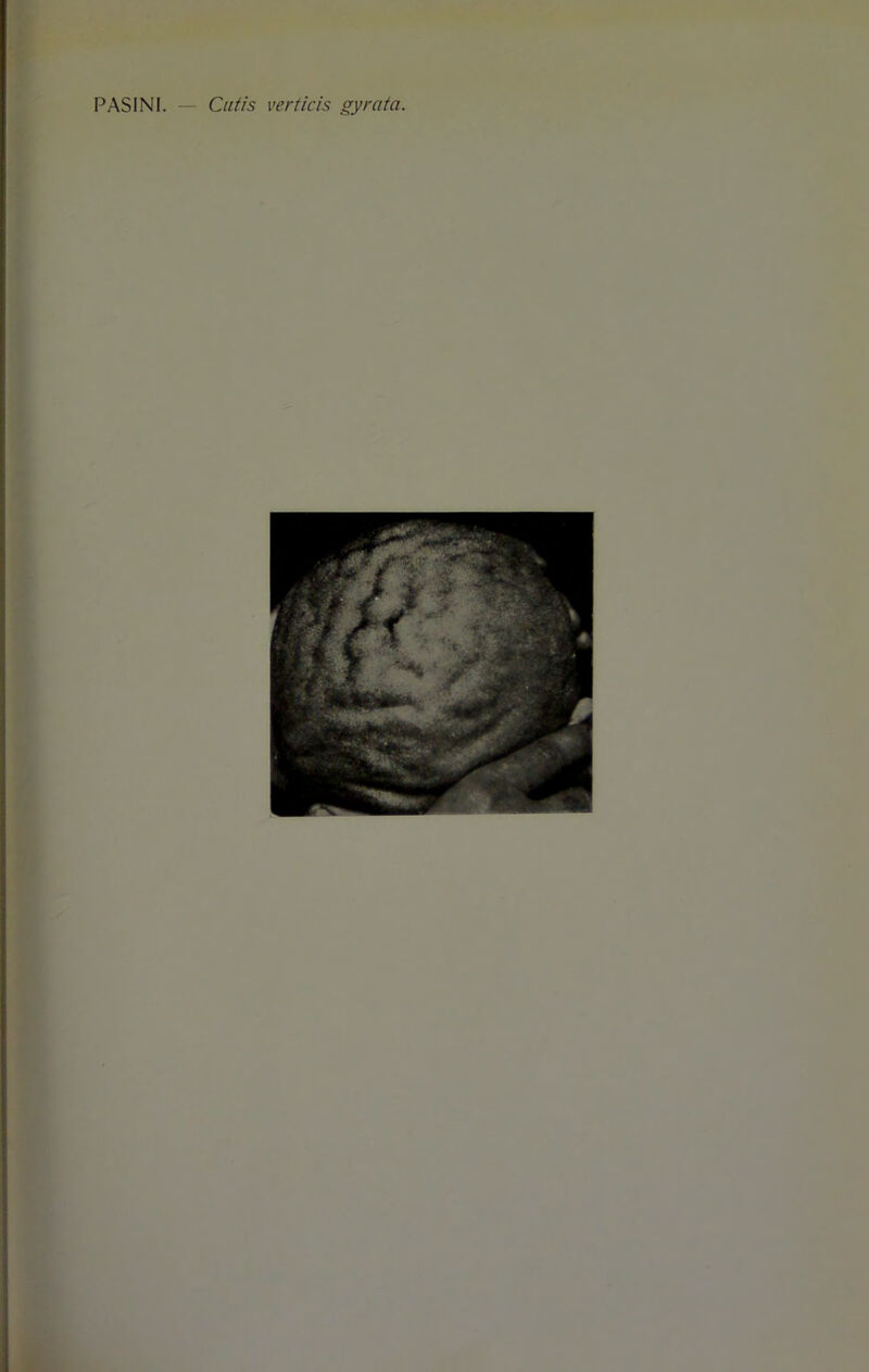 PASINI. — Cutis vertiris gyrata.