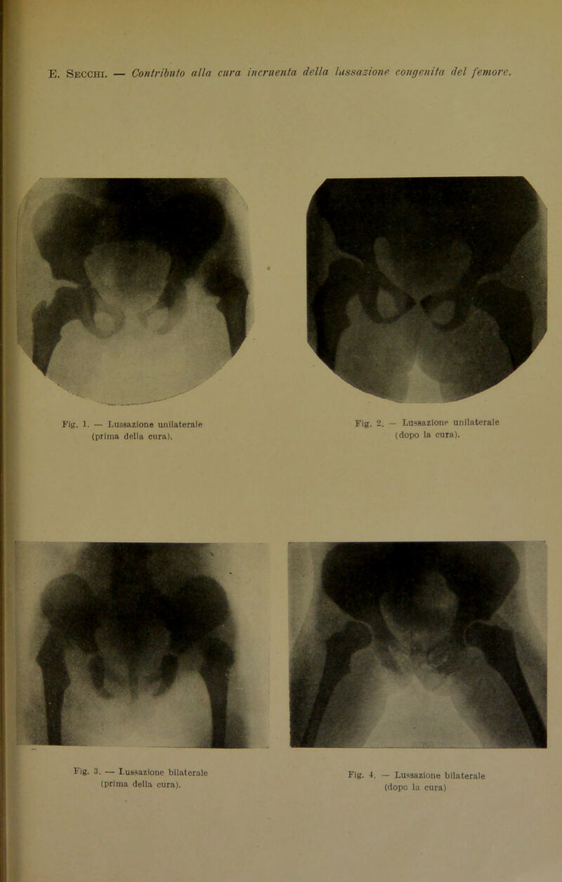 Fig. 3. — Lussazione bilaterale (prima della cura). Fig. 1. — Lussazione bilaterale (dopo la cura)