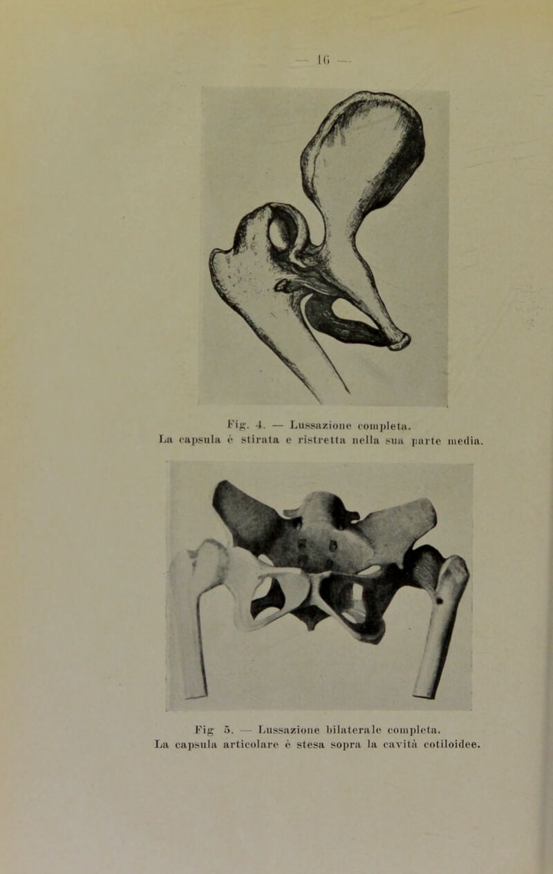 !<; Fig. 4. — Lussazione completa. La capsula è stirata e ristretta nella sua parte media.