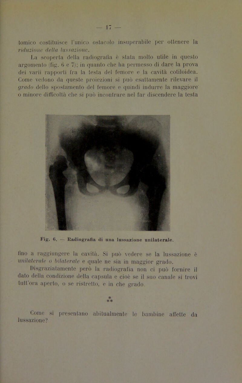 tomico costituisce l'unico ostacolo insuperabile per ottenere la riduzione della lussazione. La scoperta della radiografia è stata molto utile in questo argomento (fig. (> e 7); in quanto che ha permesso di dare la prova dei varii rapporti tra la testa del femore e la cavità cotiloidea. Come vedono da queste proiezioni si può esattamente rilevare il grado dello spostamento del femore e quindi indurre la maggiore o minore difficoltà che si può incontrare nel far discendere la testa Fig. fi. — Radiografia di una lussazione unilaterale. fino a raggiungere la cavità. Si può vedere se la lussazione è unilaterale o bilaterale e quale ne sia in maggior grado. Disgraziatamente però la radiografia non ci può fornire il dato della condizione della capsula e cioè se il suo canale si trovi tuttora aperto, o se ristretto, e in che grado * ** (-ome si presentano abitualmente le bambine affette da lussazione?