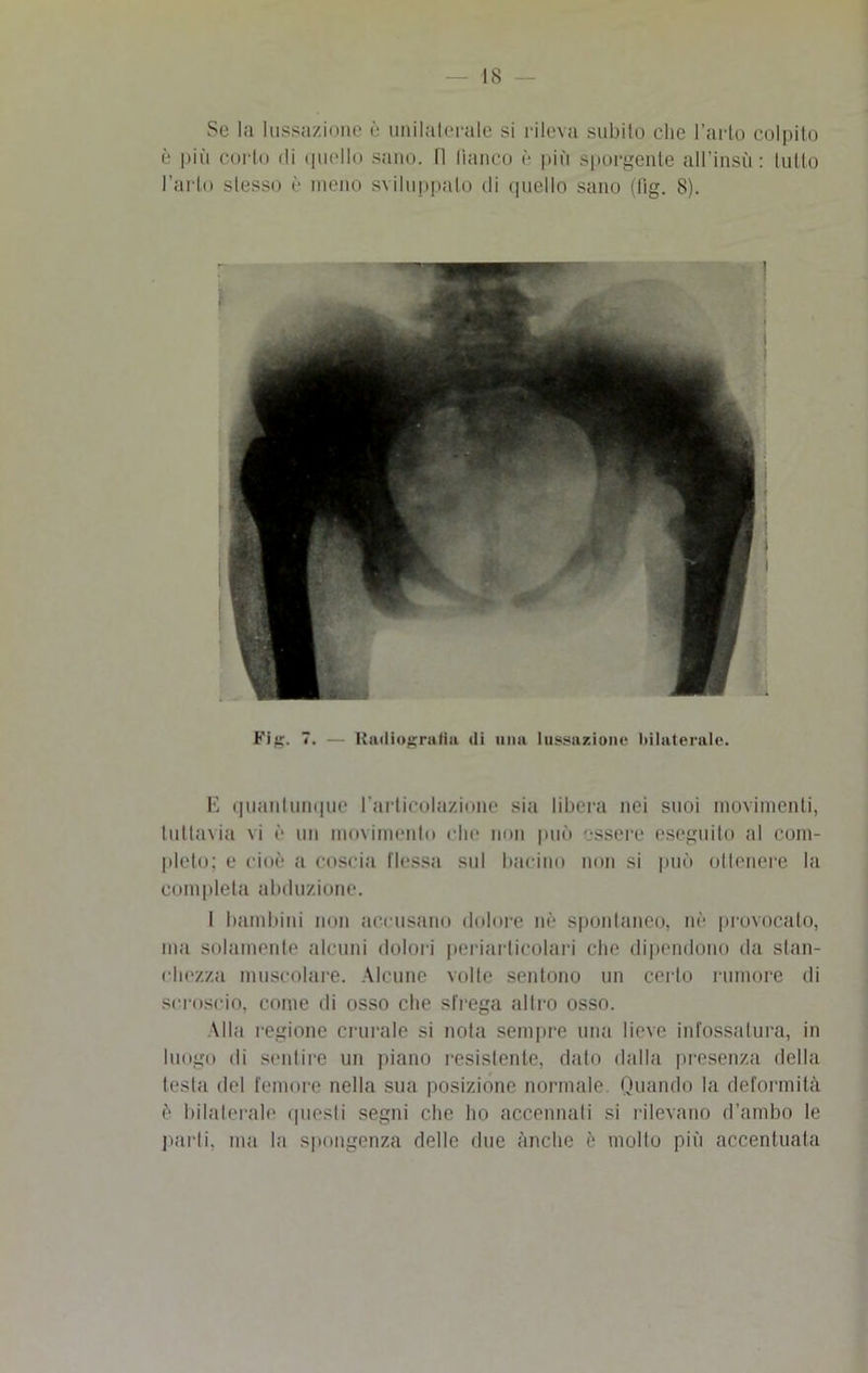 Se la lussazione è unilaterale si rileva subito che l’arto colpito è più corto di quello sano, fi fianco è più sporgente afi’insù : tutto l’arto stesso è meno sviluppalo di quello sano (fig. 8). E quantunque l'articolazione sia libera nei suoi movimenti, tuttavia vi è un movimento die non può essere eseguito al com- pleto; e cioè a coscia flessa sul bacino non si può ottenere la completa abduzione. I bambini non accusano dolore nè spontaneo, nè provocalo, ma solamente alcuni dolori periarticolari che dipendono da stan- chezza muscolare. Alcune volle sentono un certo rumore di scroscio, come di osso ctie sfrega altro osso. Alla regione crurale si nota sempre una lieve infossalura, in luogo di sentire un piano resistente, dato dalla presenza della testa del femore nella sua posizióne normale. Quando la deformità è bilaterale questi segni che ho accennati si rilevano d’ambo le parti, ma la spongenza delle due anche 6 molto più accentuata