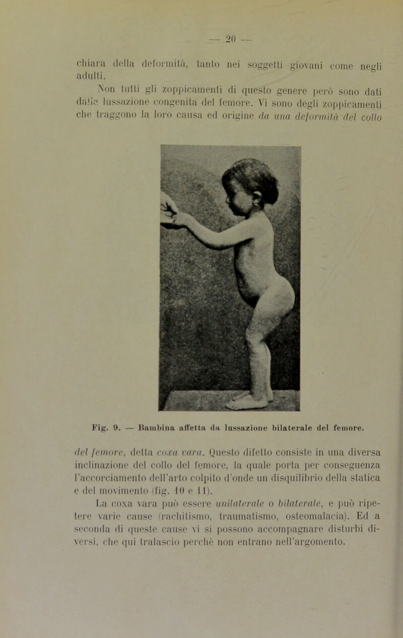 chiara della deformità, lauto nei soggetti giovani come negli adulti. Non tulli gli zoppicameli ili questo genere però sono dati dati;* lussazione congenita del femore. Vi sono degli zoppicameli che traggono la loro causa ed origine da una deformità del collo Fig. 9. — Bambina alletta da lussazione bilaterale del femore. del femore, detta coxa rara. Questo difetto consiste in una diversa inclinazione del collo del femore, la «piale porta per conseguenza l’accorciamento dell'al to colpito d’onde un disquilibrio della statica e del movimento ifig. Iil e 11). La coxa vara può essere unilaterale o bilaterale, e può ripe- tere varie cause rachitismo, traumatismo, osteomalacia). Ed a seconda di queste cause \i si possono accompagnare disturbi di- versi. che qui tralascio perchè non entrano nell’argomento.