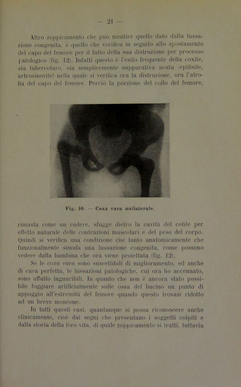 Altro zoppicameli lo die può mentire quello dato dalla lussa- zione congenita, è quello che verifica in seguito allo spostamento del capo del femore per il fatto della sua distruzione per processo patologico (fig. 12). Infatti questo è l’esito frequente della coxite, sia tubercolare, sia semplicemente suppurativa acuta (epifìsite, artrosinovite) nella quale si verifica ora la distruzione, ora l’atro- fia del capo del femore. Perciò la porzione del collo del femore, Fig. IO. — Coxa vara unilaterale. rimasta come un rudere, sfugge dietro la cavità del colile per effetto naturale delle contrazioni muscolari e del peso del corpo. Quindi si verifica una condizione che tanto anatomicamente che funzionalmente simula una lussazione congenita, come possono vedere dalla bambina che ora viene proiettata (fig. 12). Se le co.ra rara sono suscettibili di miglioramento, ed anche di cura perfetta, le lussazioni patologiche, cui ora ho accennato, sono affatto inguaribili. In quanto che non è ancora stato possi- bile foggiare artificialmente sulle ossa del bacino un punto di appoggio all’estremità del femore quando questo trovasi ridotto ad un breve moncone. In tutti questi casi, quantunque si possa riconoscere anche clinicamente, cioè dai segni che presentano i soggetti colpiti e dalla storia della loro vita, di quale zoppicamento si tratti, tuttavia