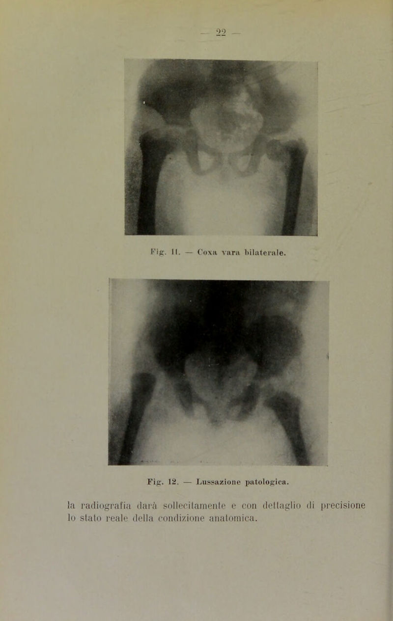 99 j Fig. 11. — Cova vara bilaterale. la radiografiti darà sollecilainenle e con dettaglio di precisione lo stato reale della condizione anatomica.