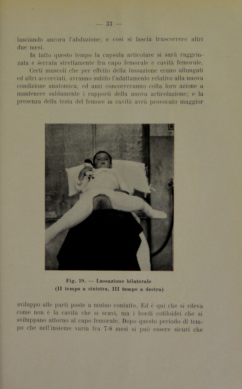 lasciando ancora I’ahduzione; e così si lascia trascorrere altri due mesi. In tutto questo tempo la capsula articolare si sarà raggrin- zata e serrata strettamente fra capo femorale e cavità femorale. Gerii muscoli che per effetto della lussazione erano allungati ed altri accorciali, avranno subito l’adattamento relativo alla nuova condizione anatomica, ed anzi concorreranno colla loro azione a mantenere saldamente i rapporti della nuova articolazione; e la presenza della testa del femore in cavità avrà provocato maggior Fig. 19. — Lussazione bilaterale (II tempo a sinistra, III tempo a destra) sviluppo alle parti poste a mutuo contatto. Ed è qui che si rileva come non è la cavità che si scavi, ma i bordi cotiloidei che si sviluppano attorno al capo femorale. Dopo questo periodo di tem- po che nell insieme varia fra 7-8 mesi si può essere sicuri che