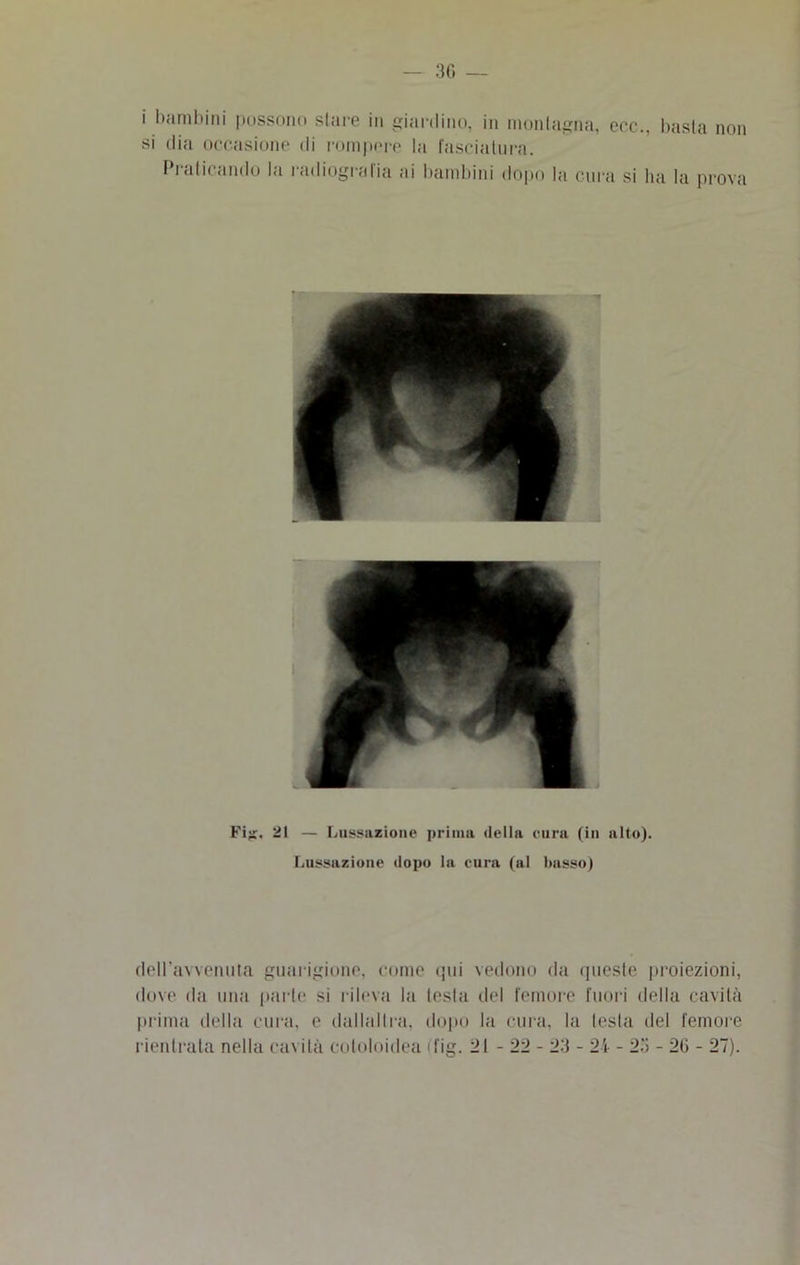 i bambini possono stare in giardino, in montagna, eoe., basta non si dia occasione di rompere la fasciatura. Praticando la radiografia ai bambini dopo la cura si ha la prova Fi;r. 21 — Lussazione prima della cura (in alto). Lussazione dopo la cura (al Imsso) deiravvenuta guarigione, come qui vedono da queste proiezioni, dove da una parte si rileva la lesla del femore fuori della cavità prima della cura, e dallallra, dopo la cura, la lesta del femore rientrata nella cavila cotoloidea (fig. il - 22 - 23 - 24 - 23 - 26 - 27).